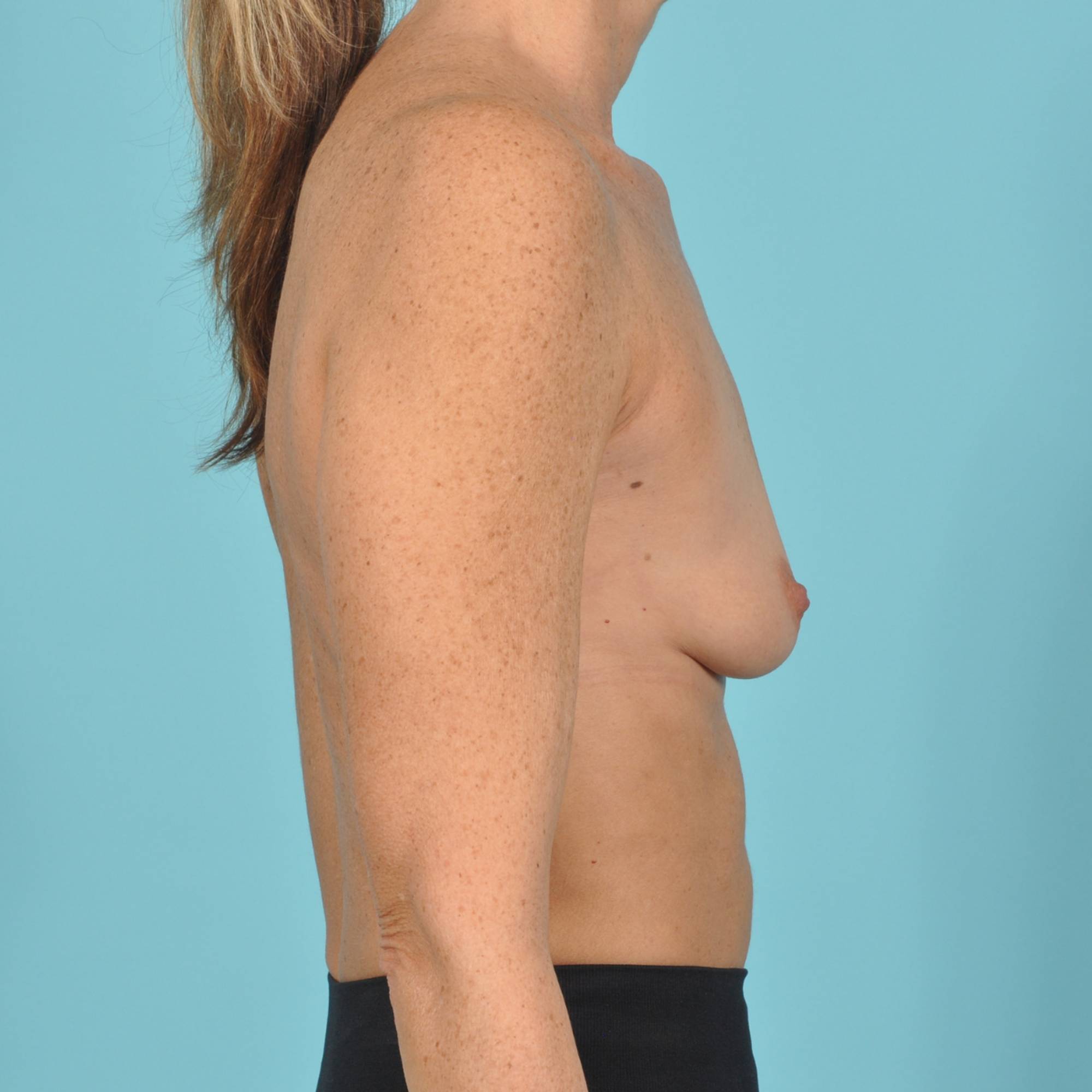 Breast Augmentation Before & After Image