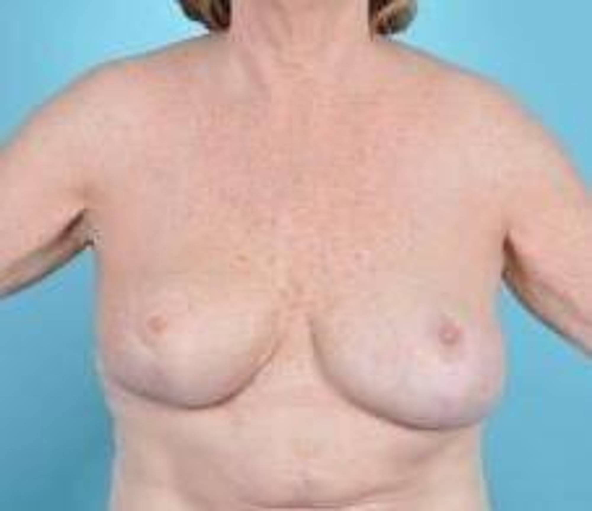 Fat Grafting To The Breast Before & After Image