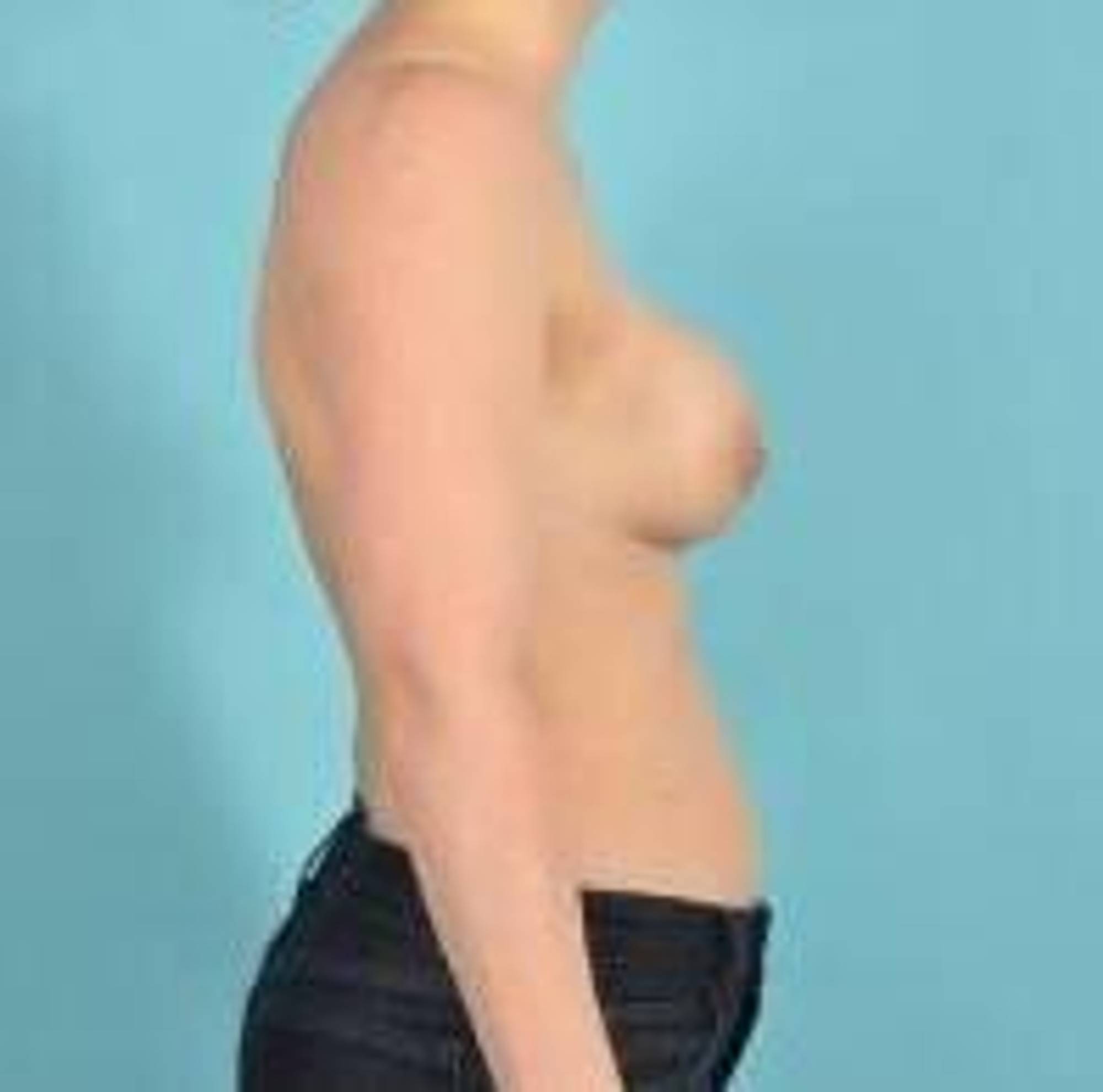 Breast Implant Revision Before & After Image