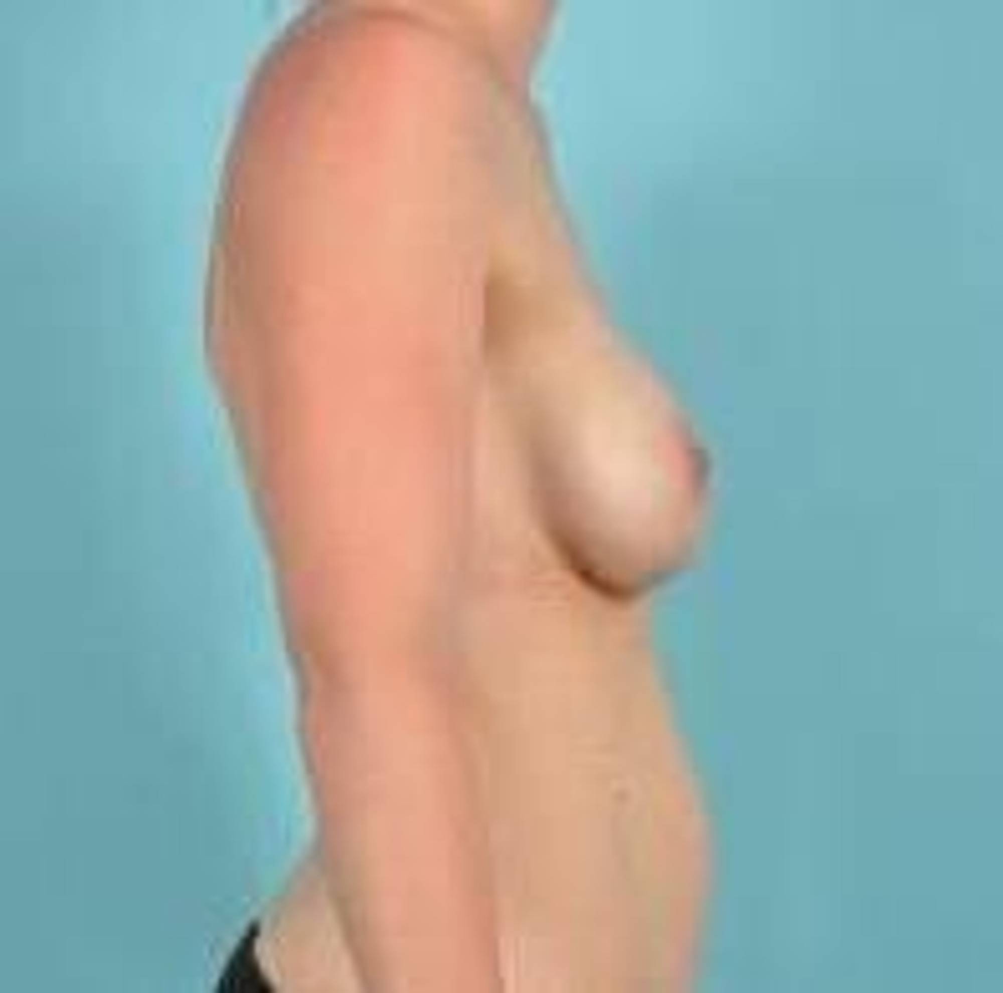 Breast Implant Revision Before & After Image