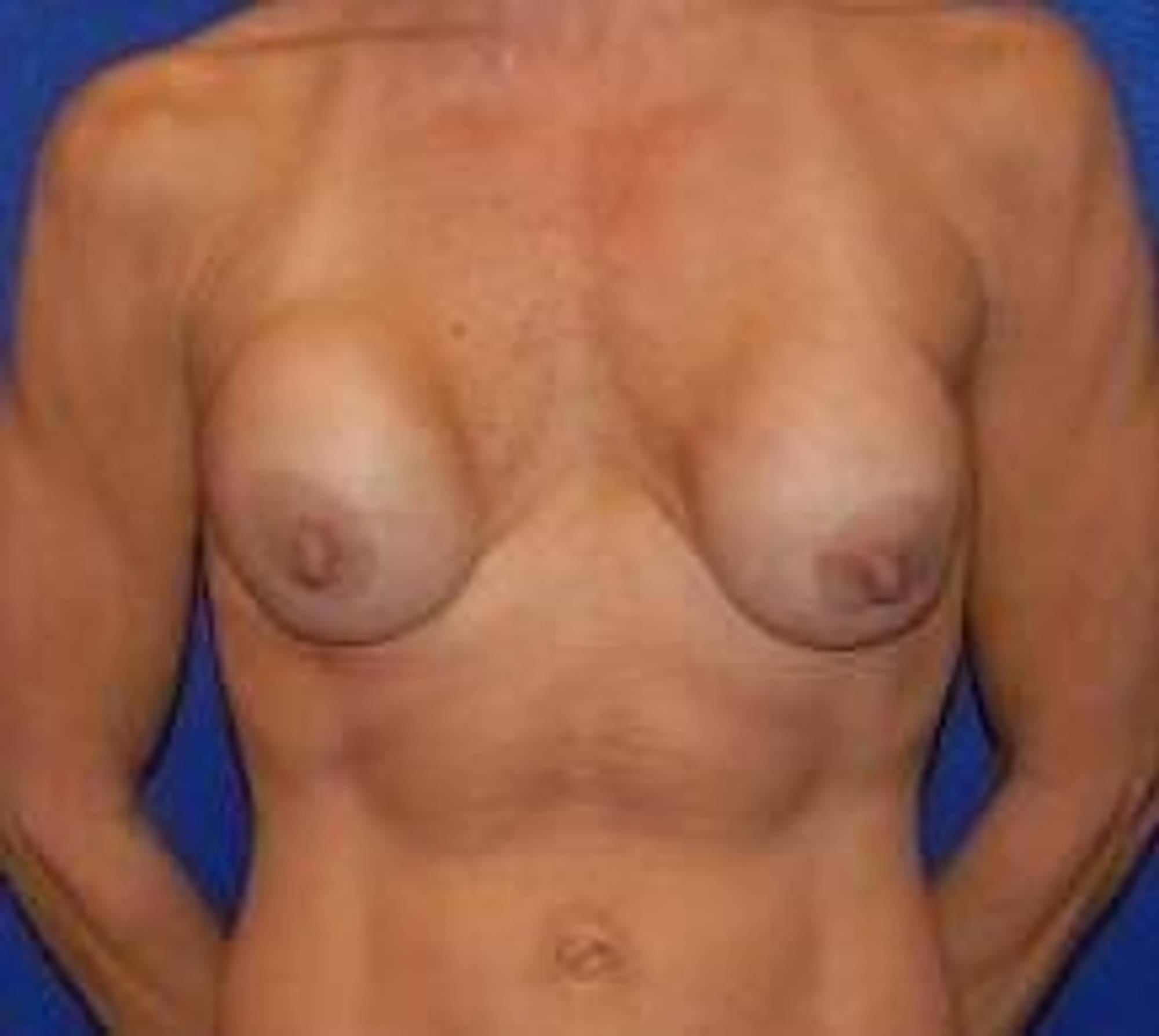Breast Implant Revision Before & After Image