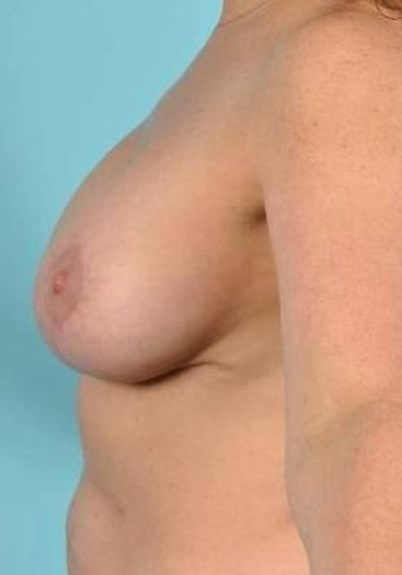 Breast Implant Revision Before & After Image
