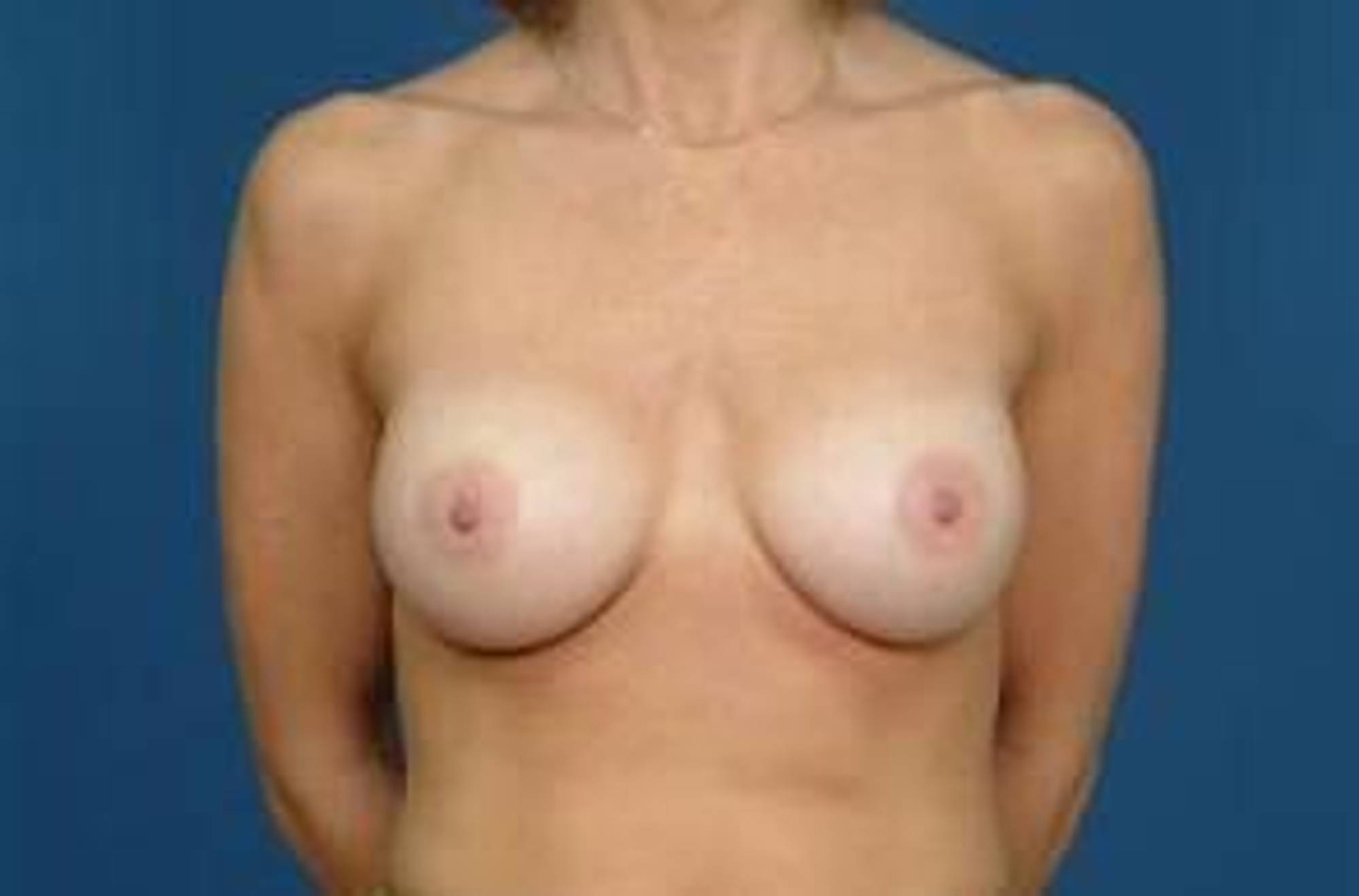 Breast Implant Revision Before & After Image