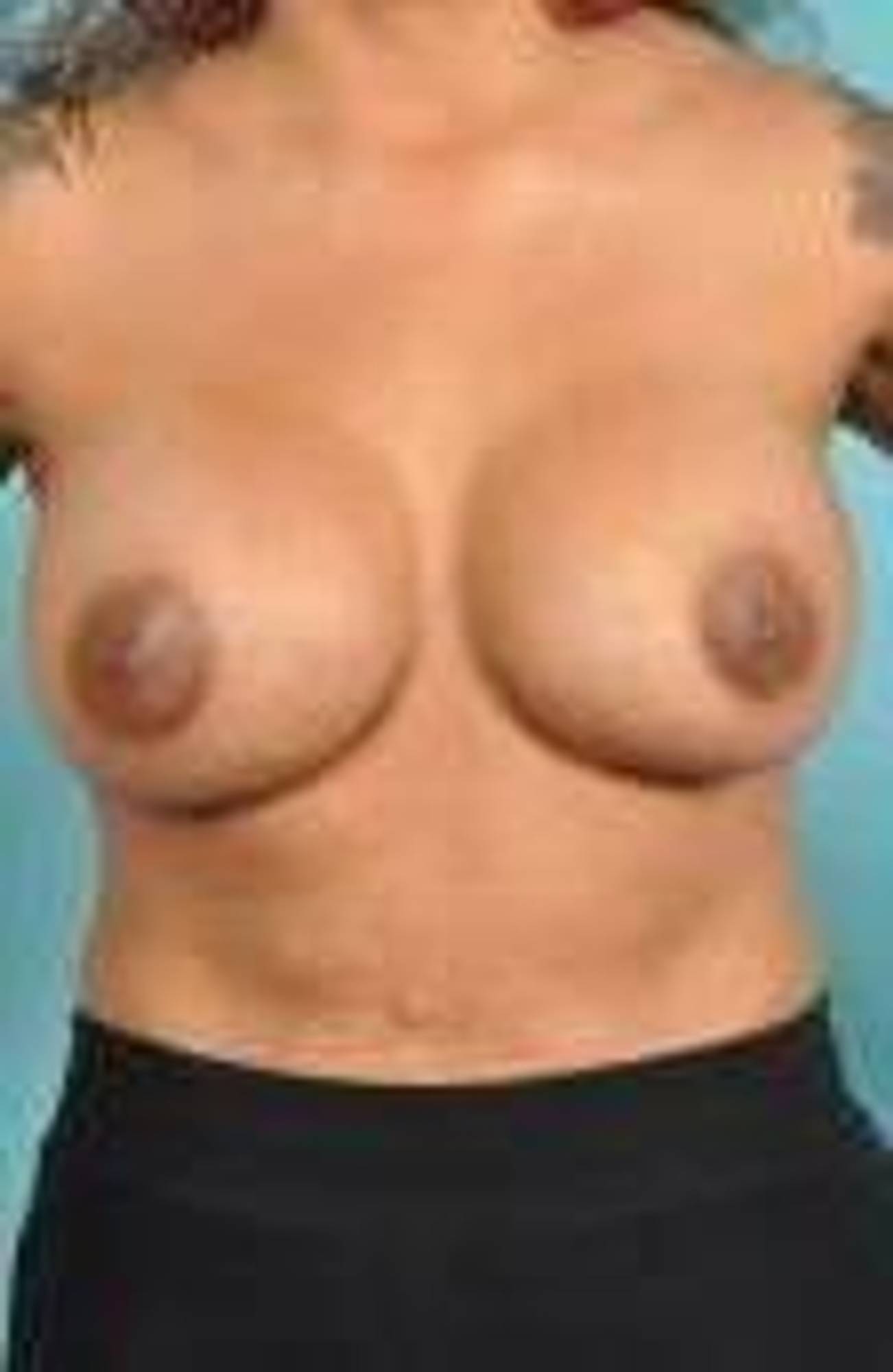 Breast Implant Revision Before & After Image