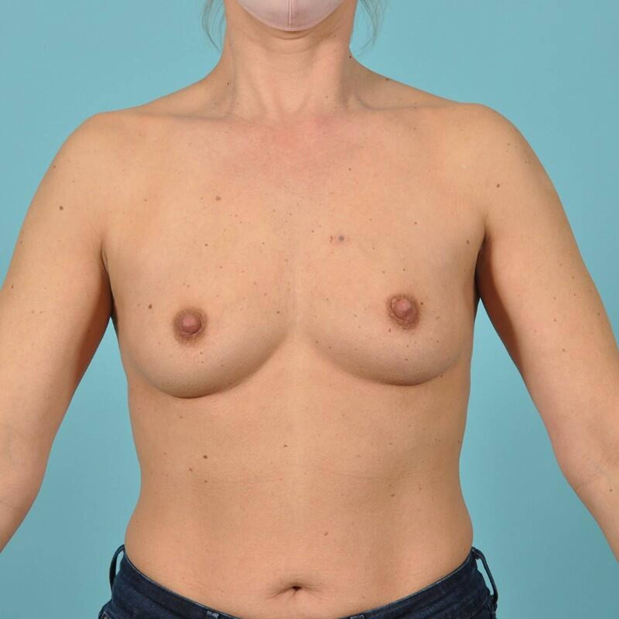 Breast Implant Revision Before & After Image