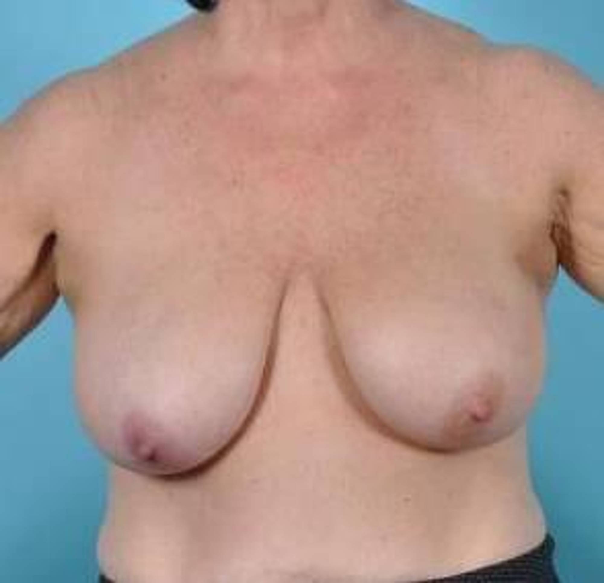 Breast lift Before & After Image
