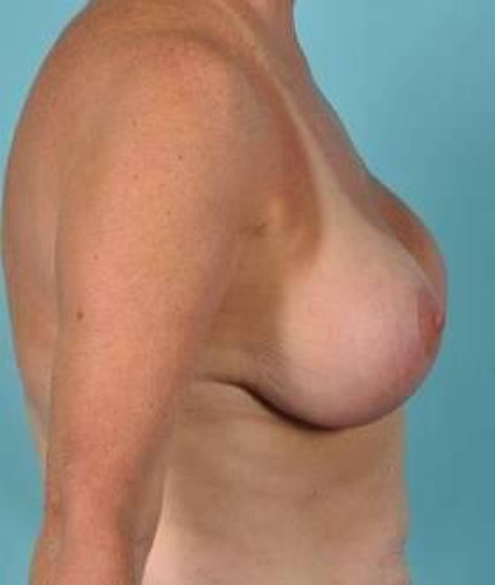 Breast lift Before & After Image