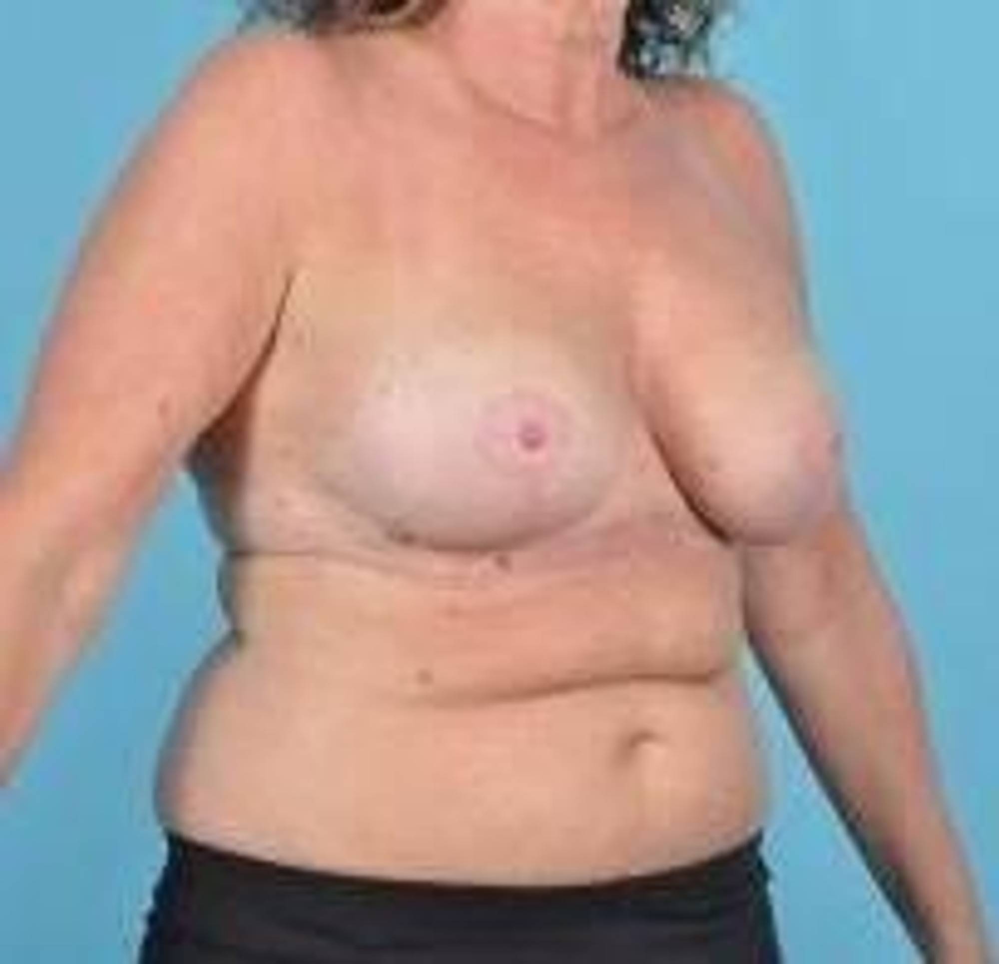 Breast lift Before & After Image