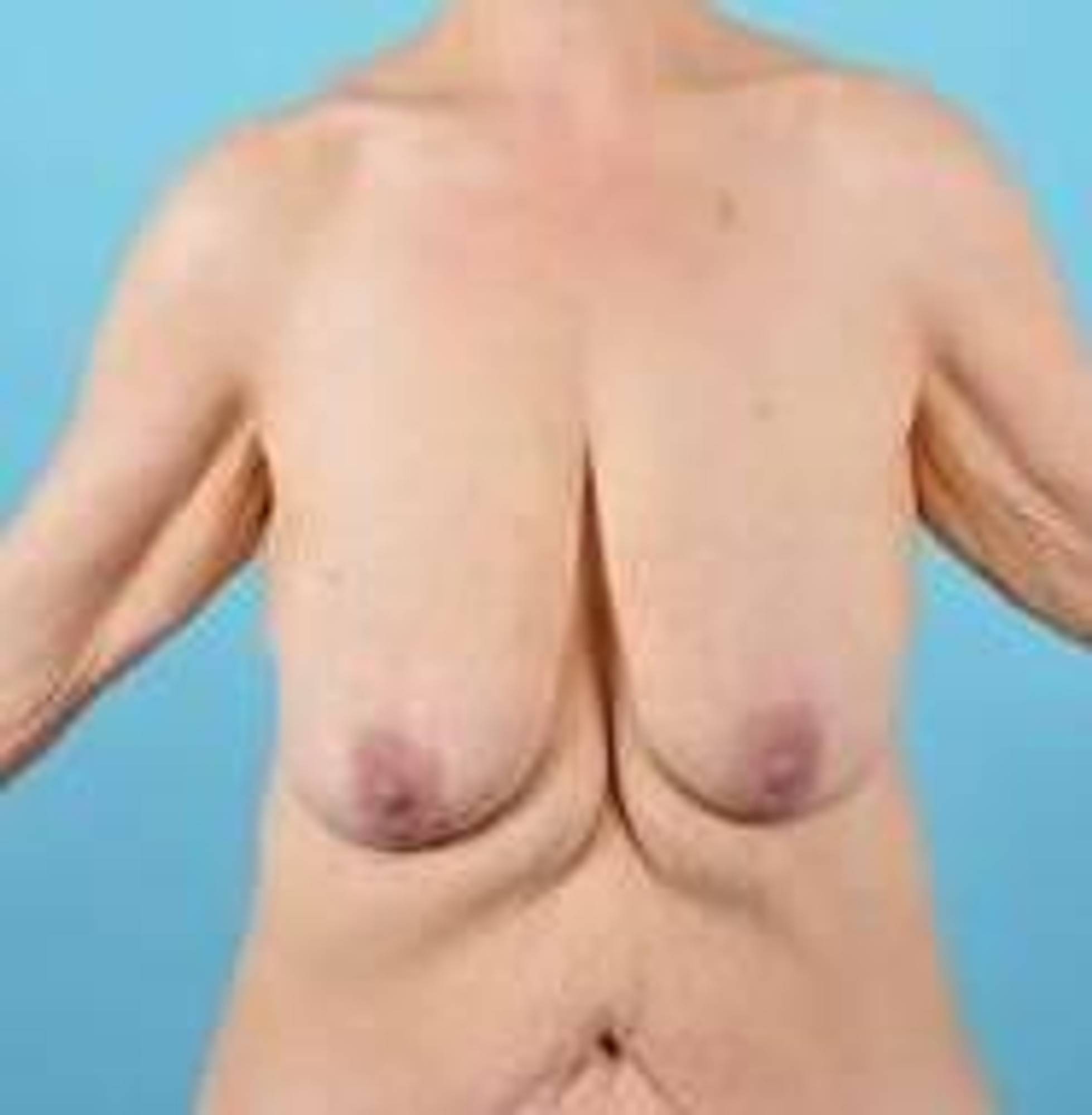 Breast lift Before & After Image