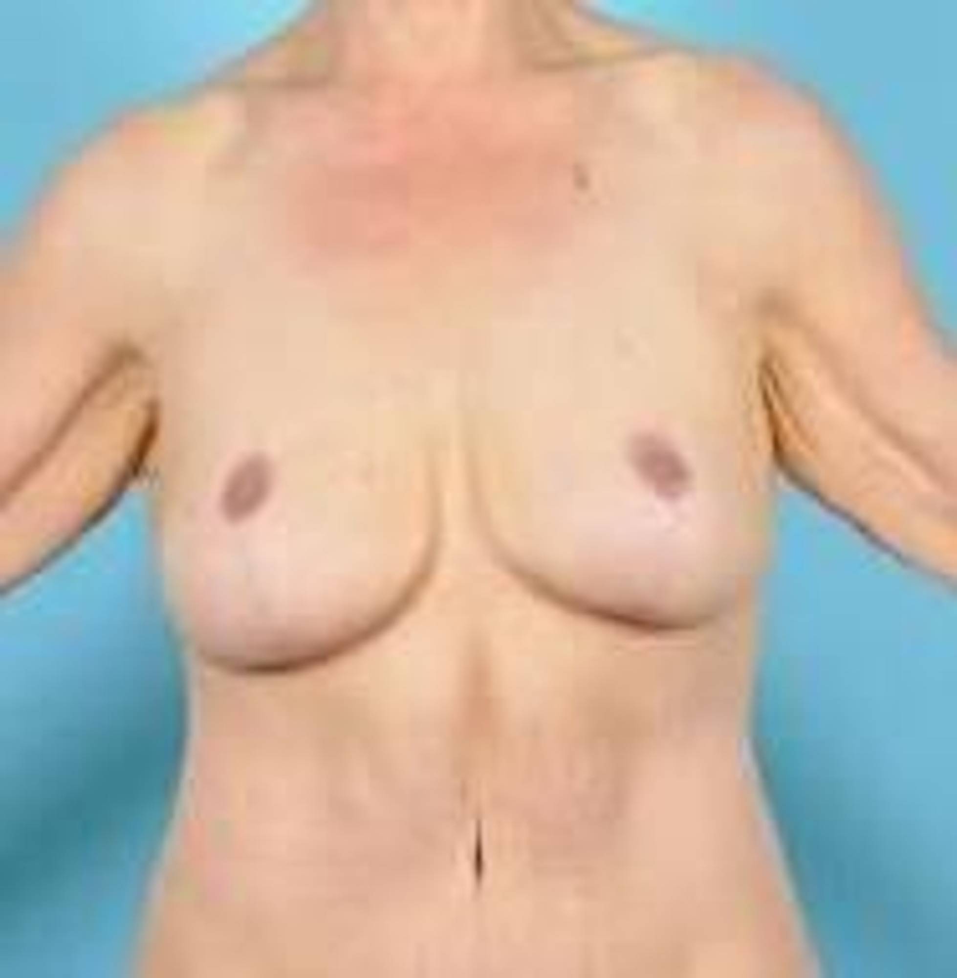 Breast lift Before & After Image