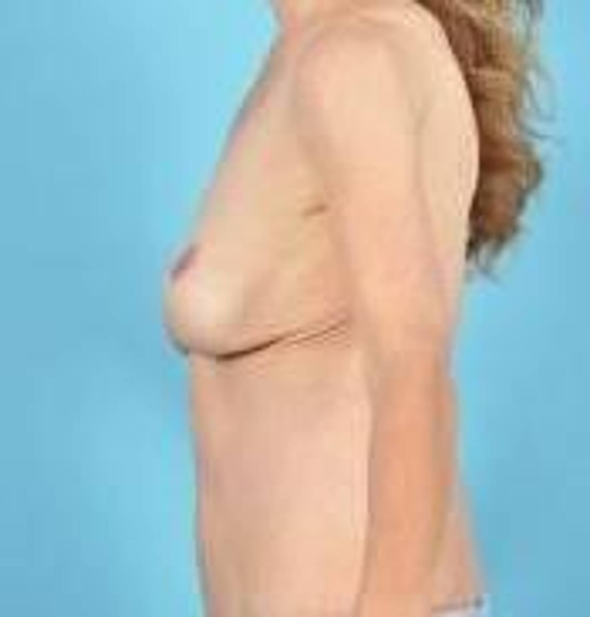 Breast lift Before & After Image