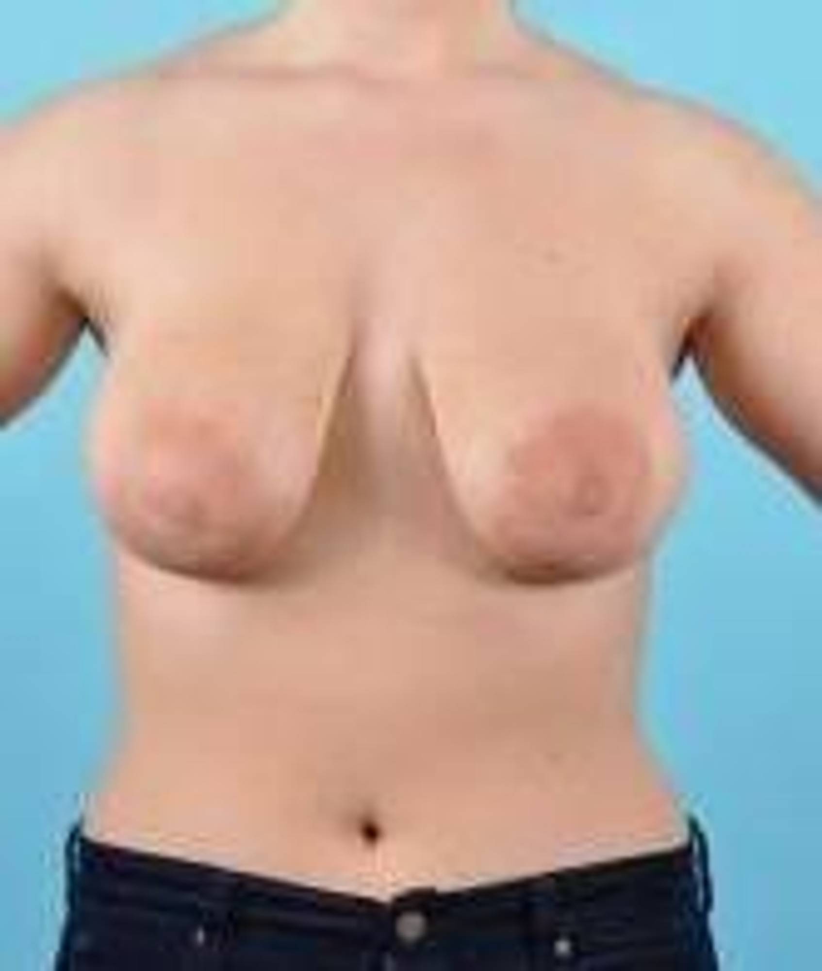 Breast lift Before & After Image