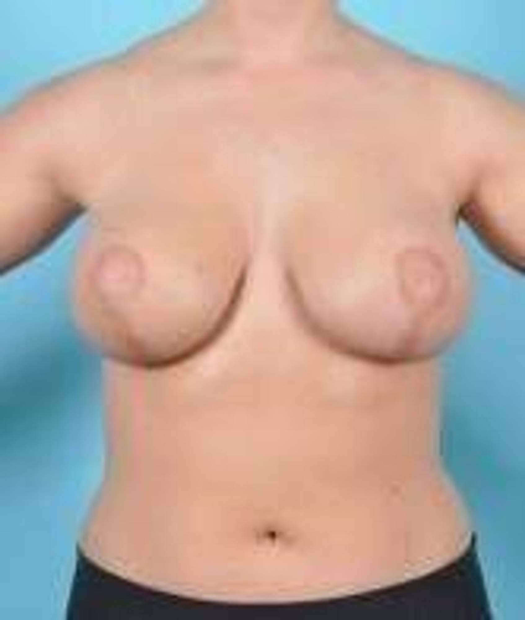 Breast lift Before & After Image