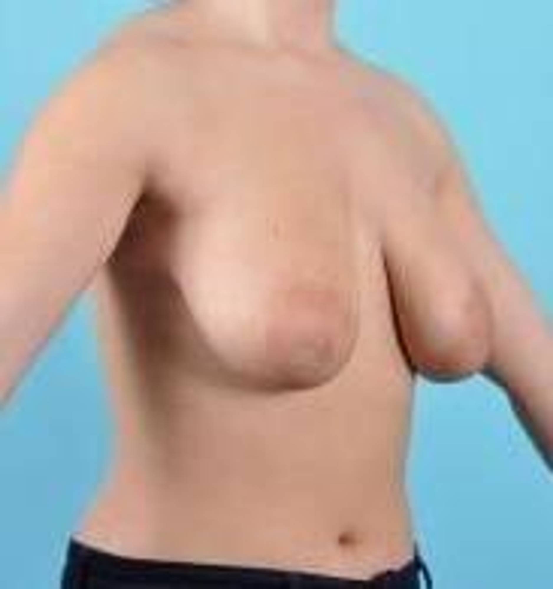 Breast lift Before & After Image