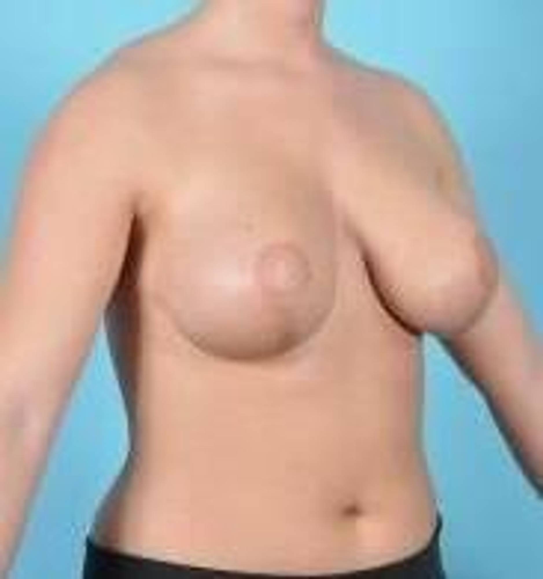 Breast lift Before & After Image
