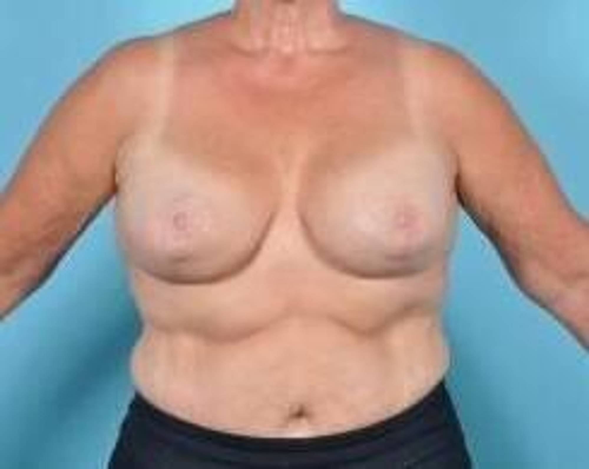 Breast lift Before & After Image