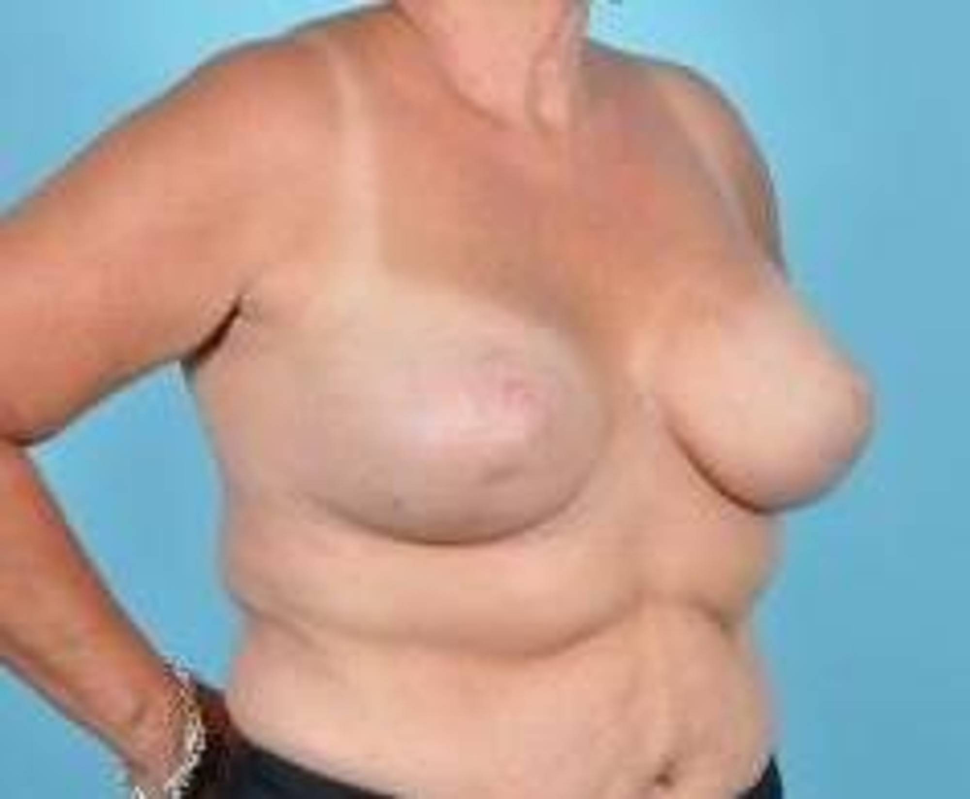 Breast lift Before & After Image