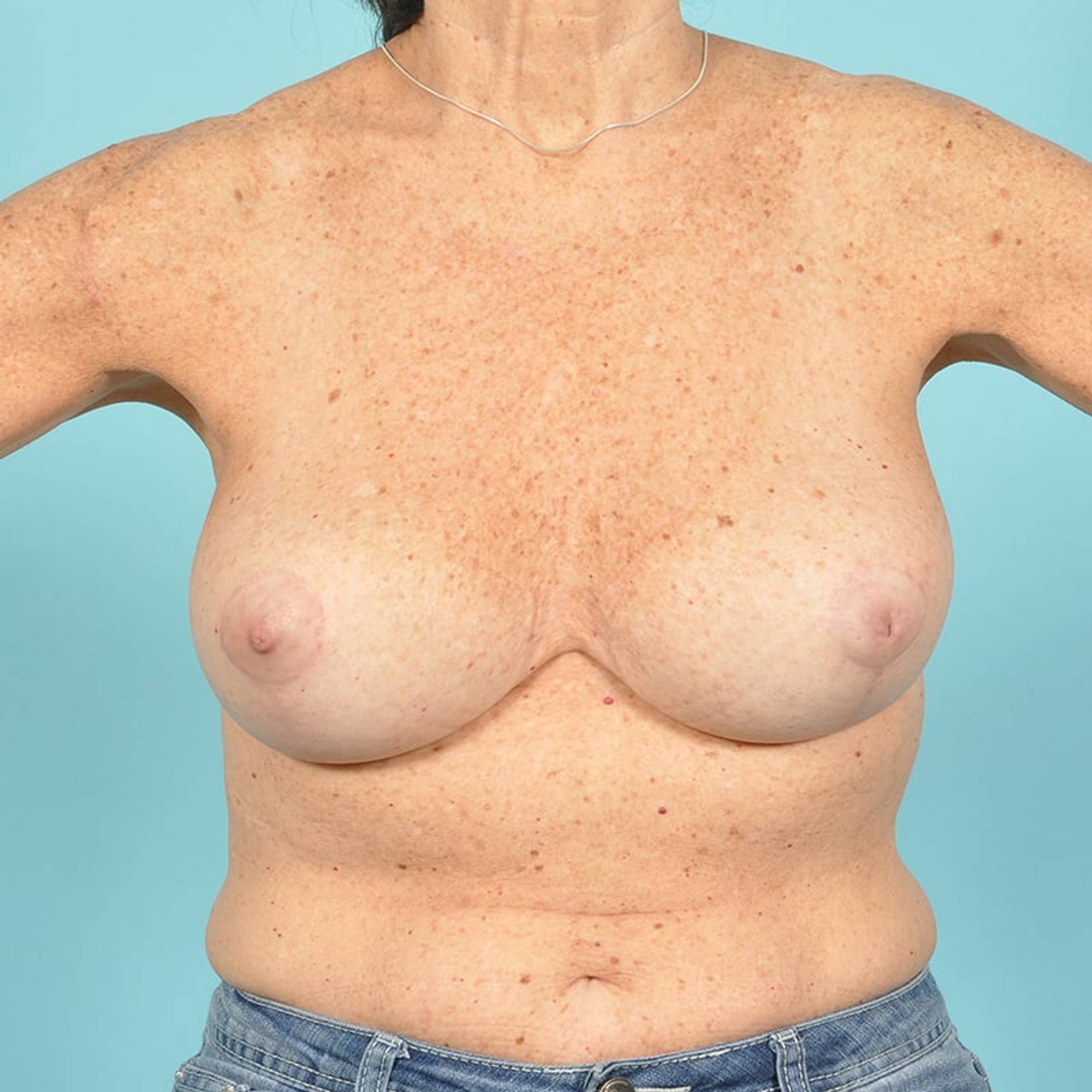 Breast Reduction For Women Before & After Image