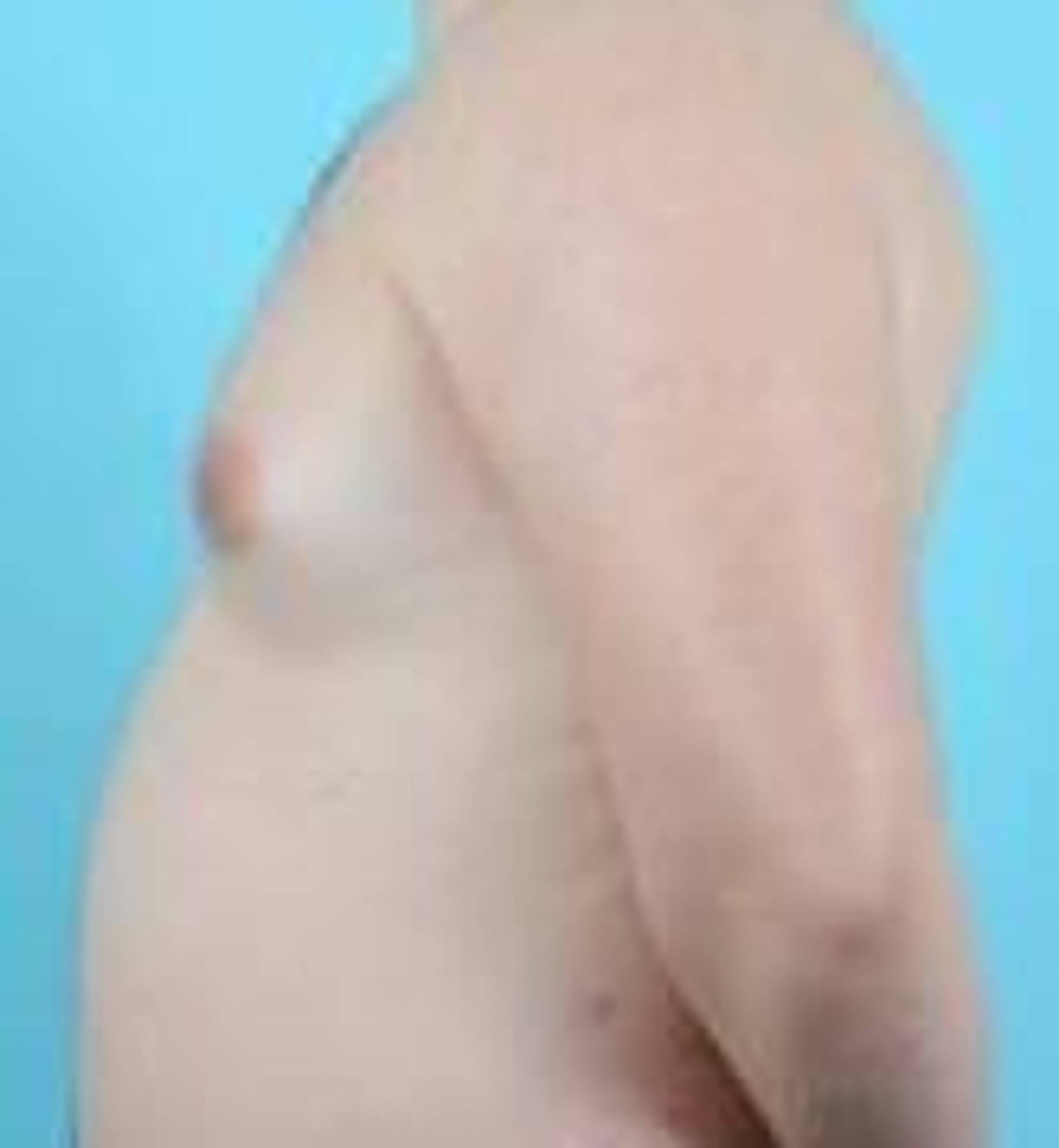 Breast Reduction For Men Before & After Image