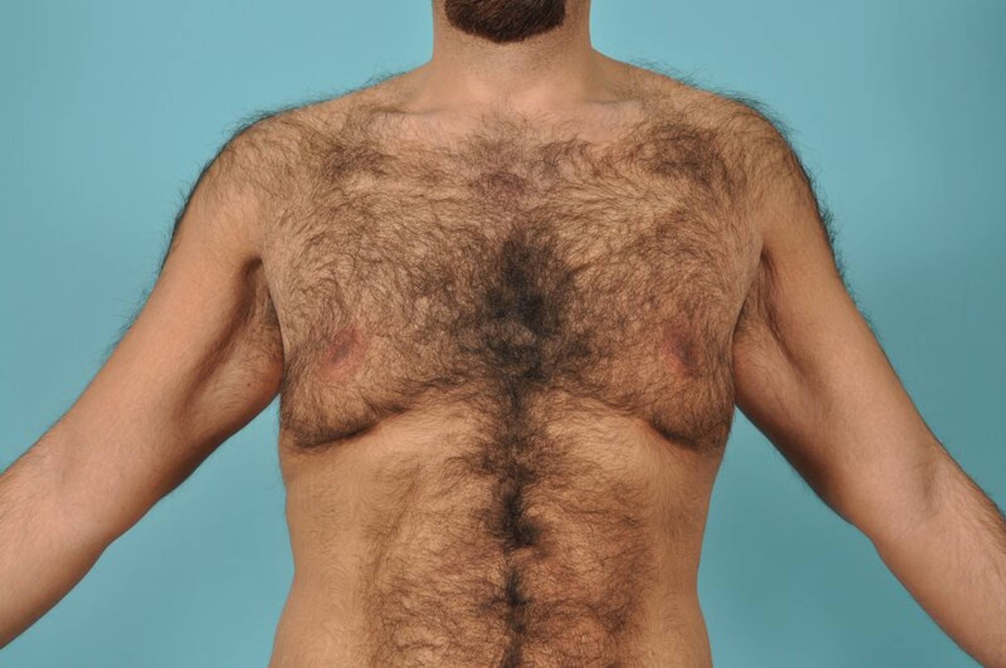 Breast Reduction For Men Before & After Image