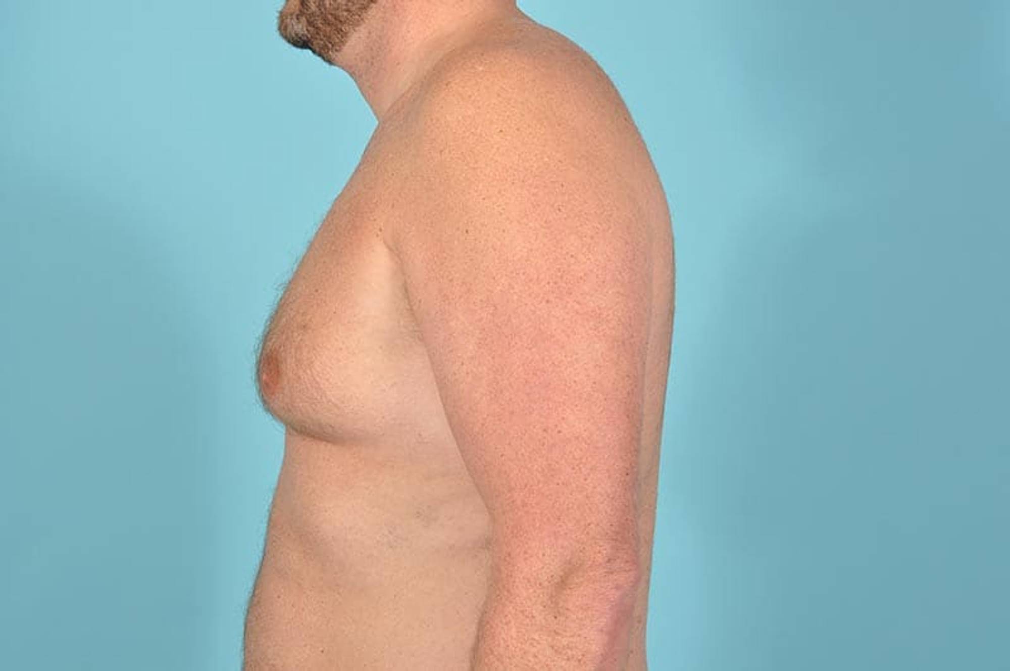 Breast Reduction For Men Before & After Image