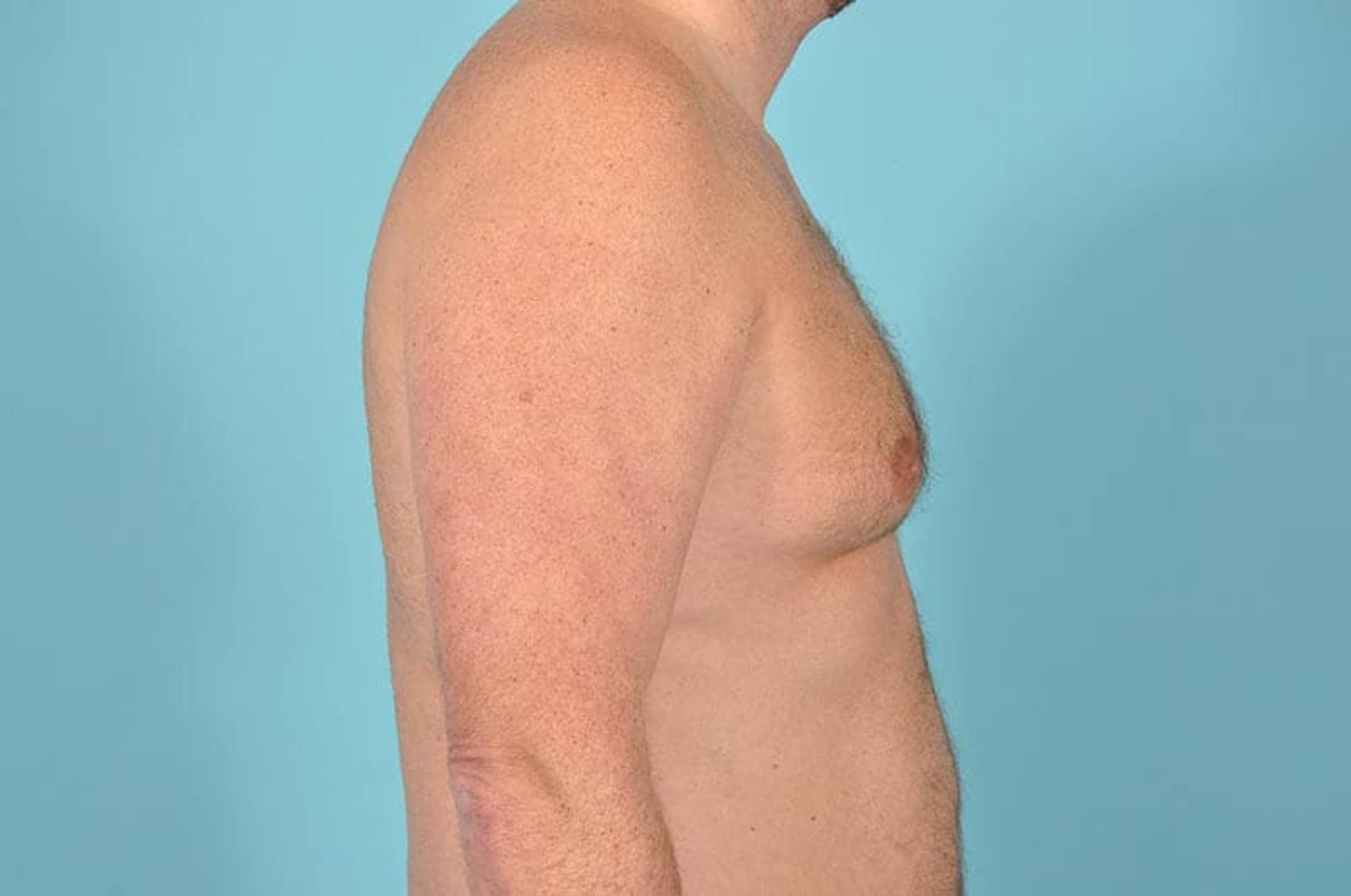 Breast Reduction For Men Before & After Image