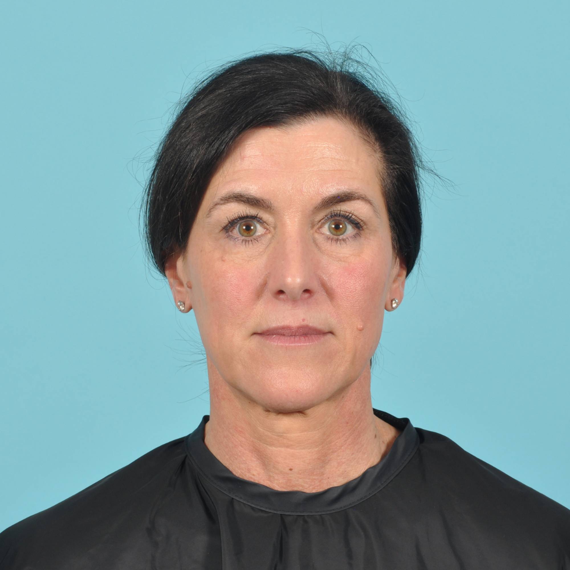 Blepharoplasty Before & After Image