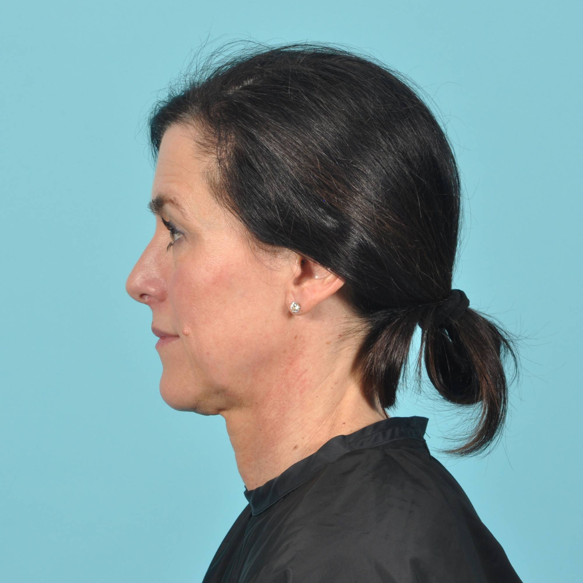 Blepharoplasty Before & After Image