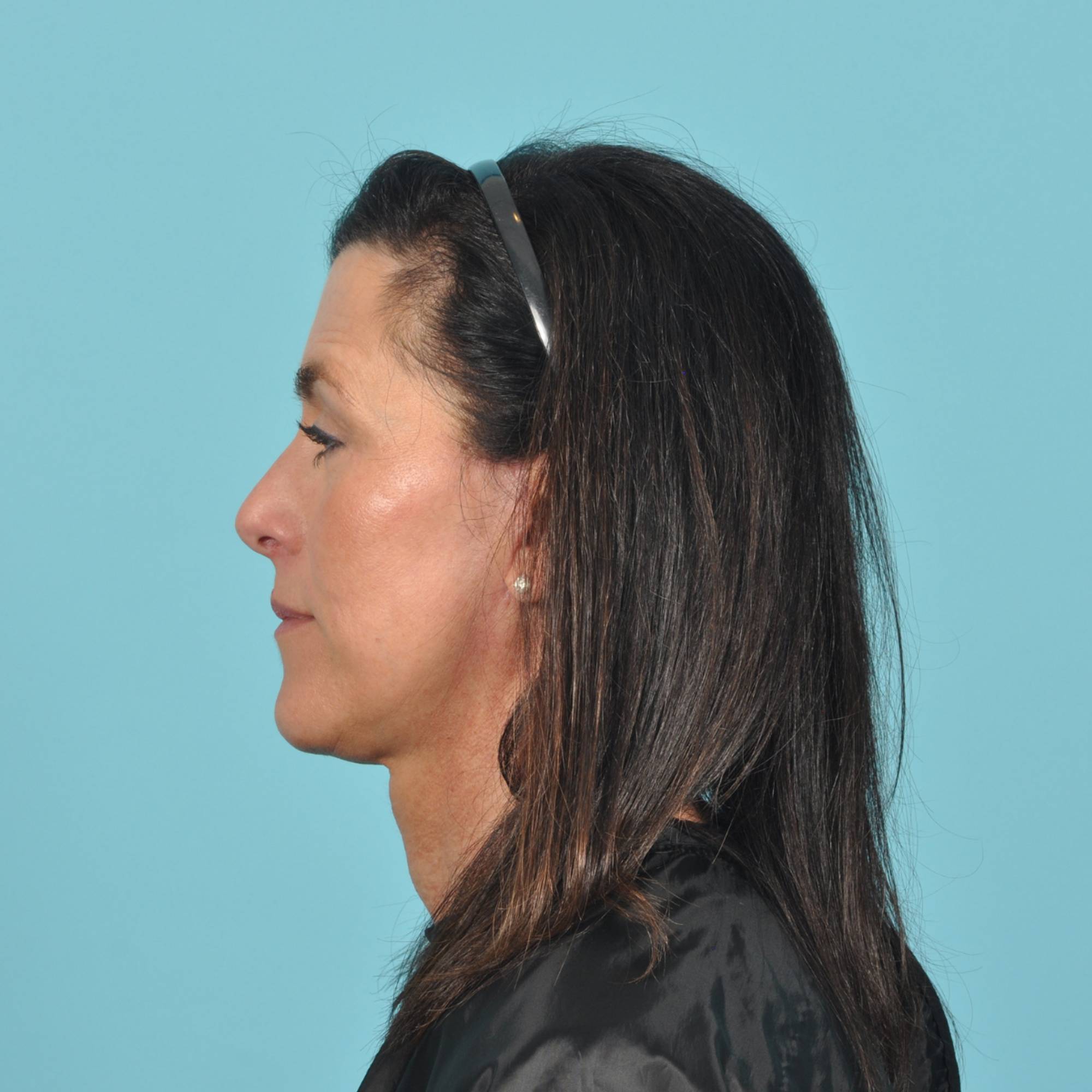 Blepharoplasty Before & After Image