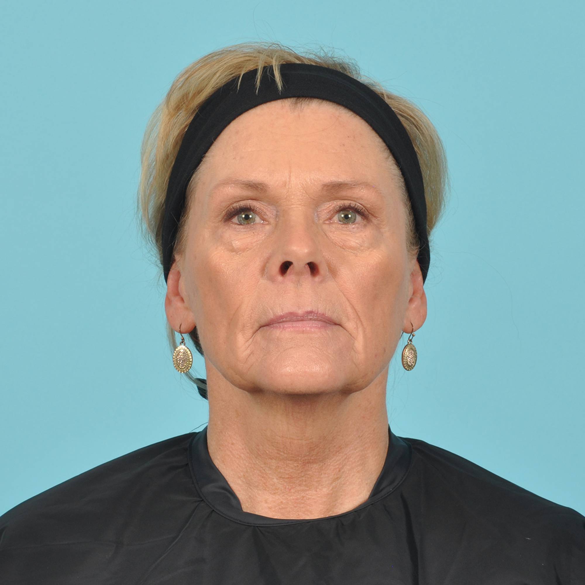 Blepharoplasty Before & After Image