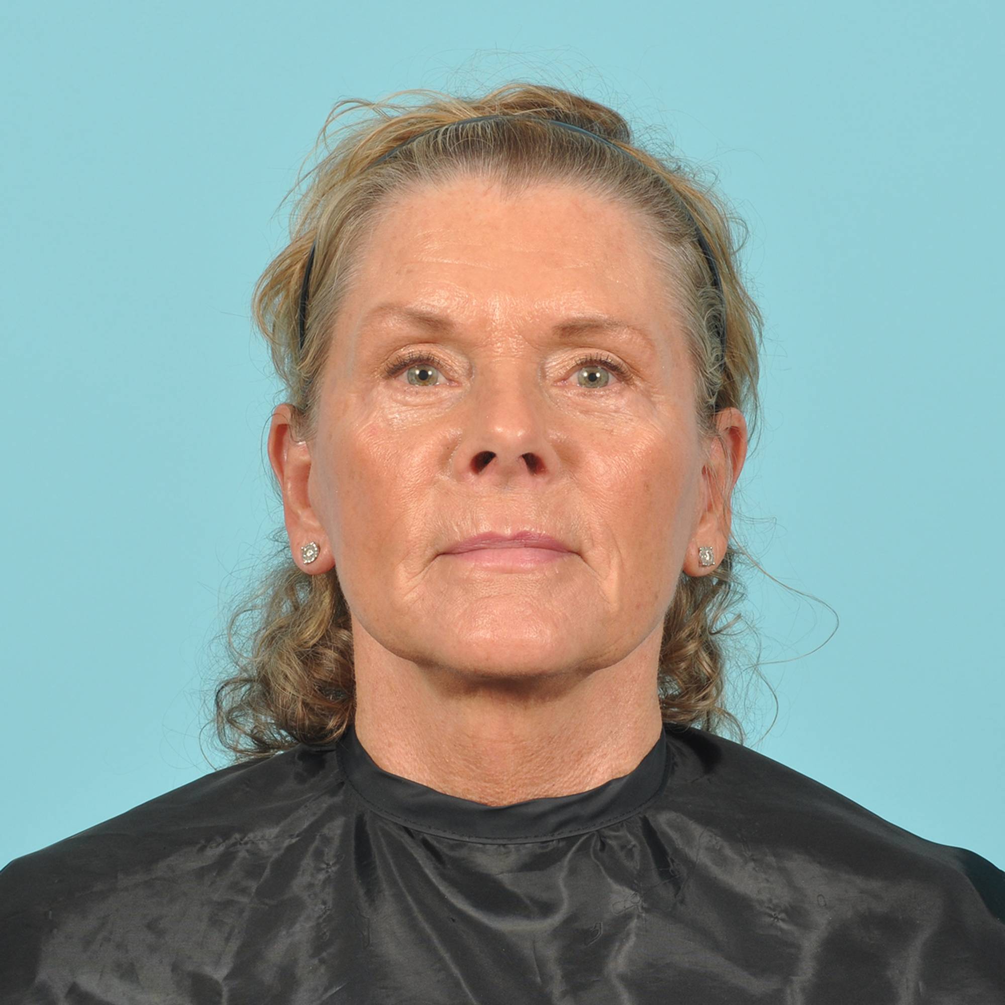 Blepharoplasty Before & After Image