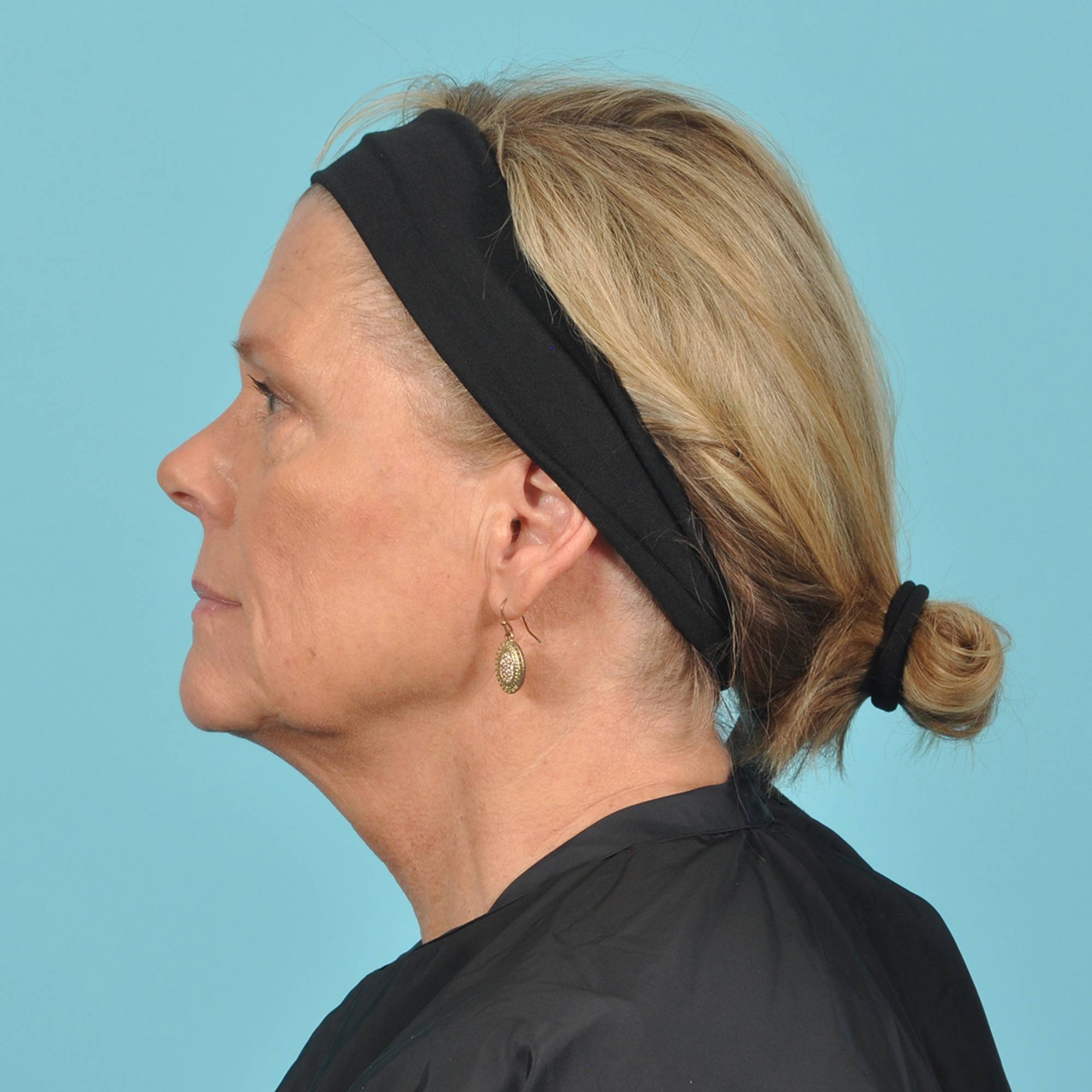 Blepharoplasty Before & After Image