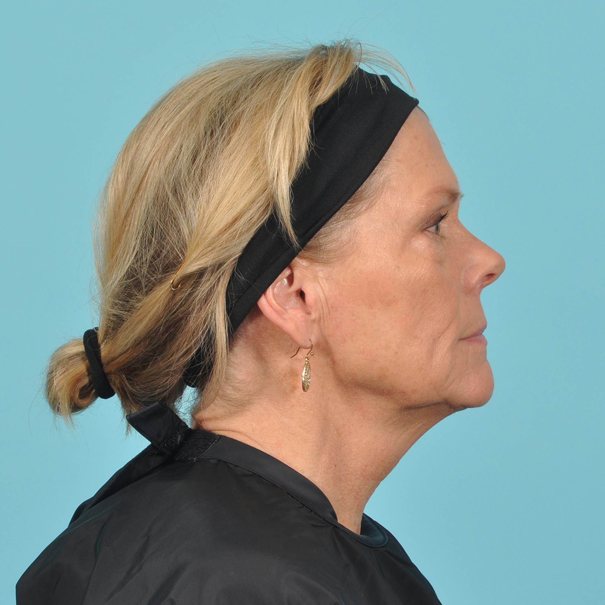  Before & After Image