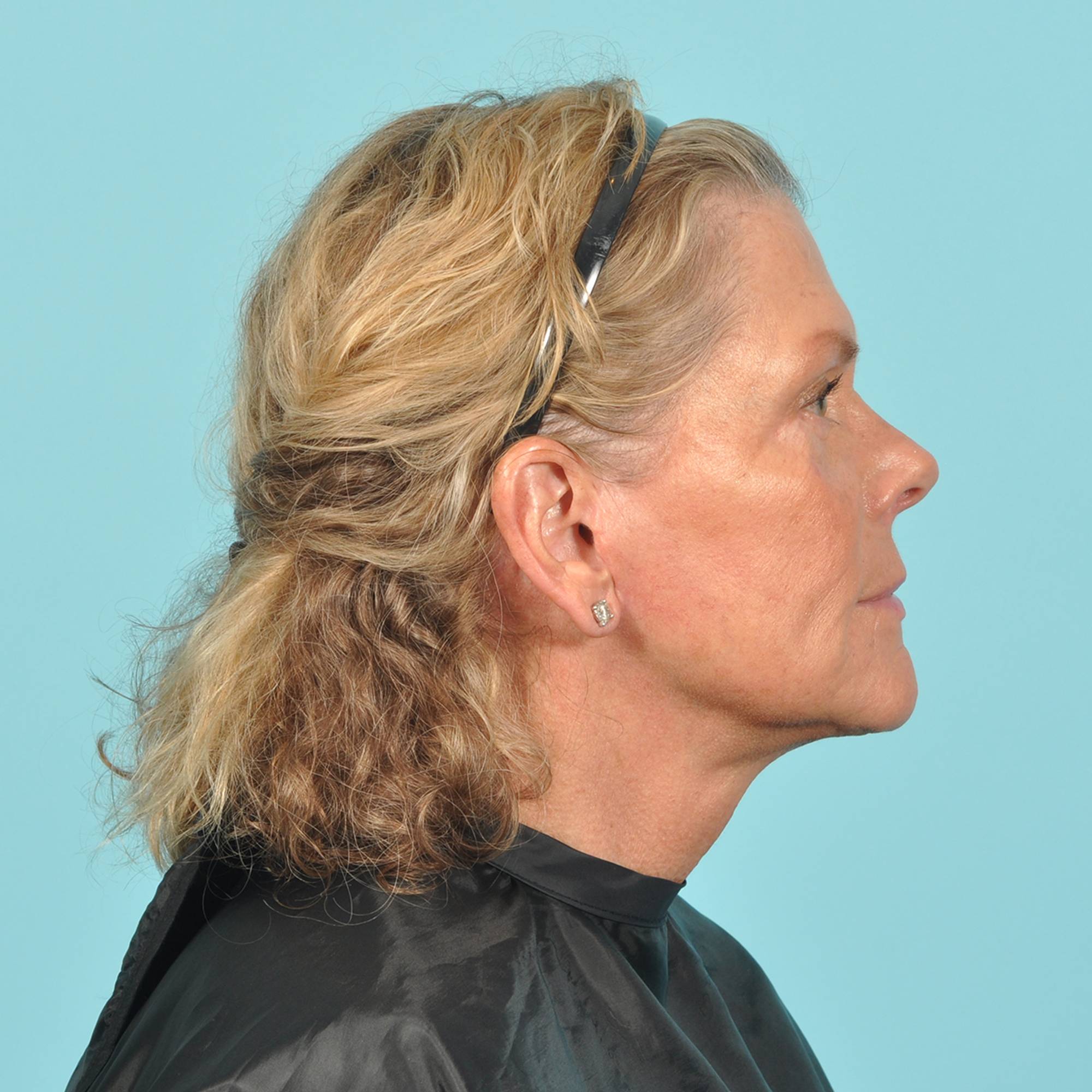  Before & After Image