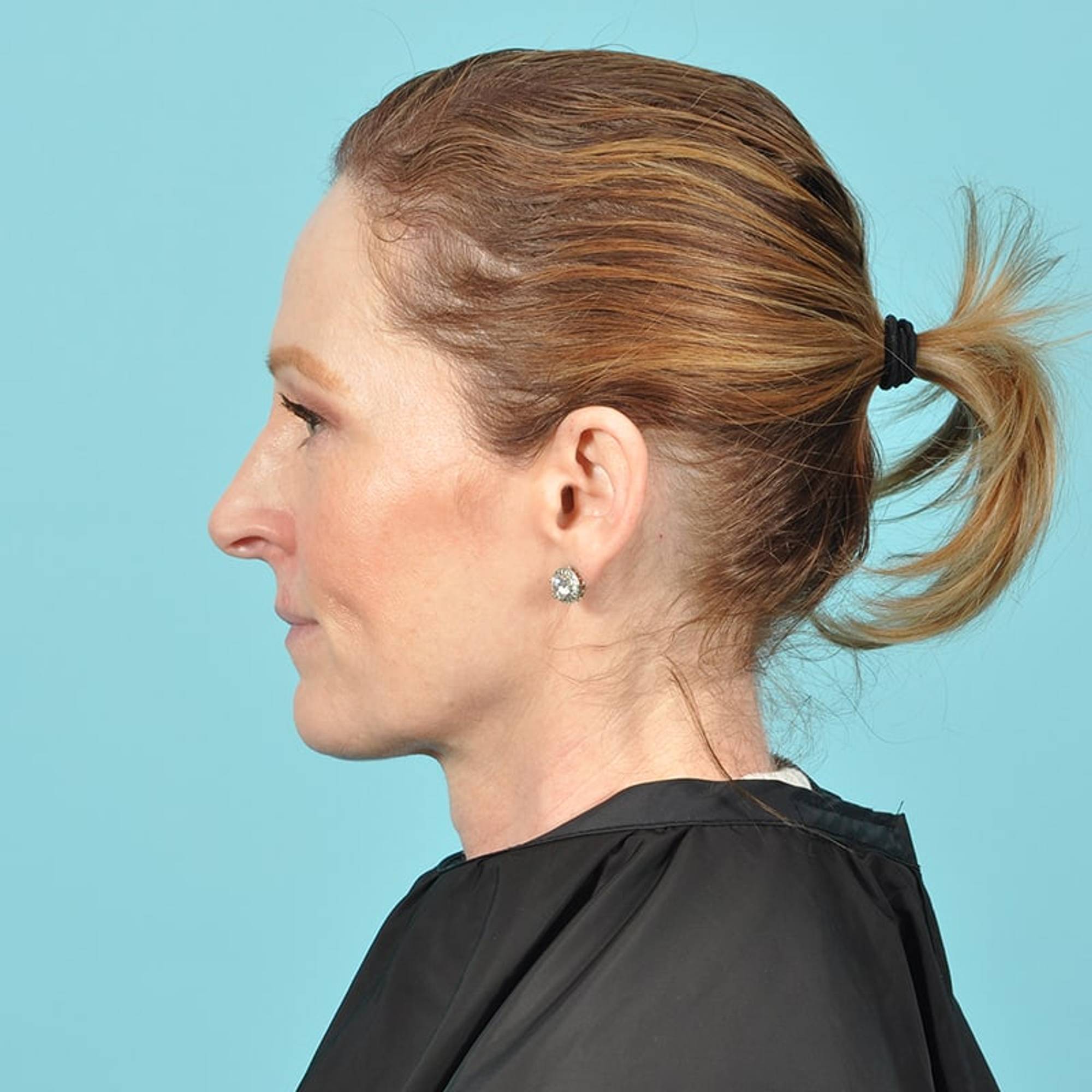 Blepharoplasty Before & After Image