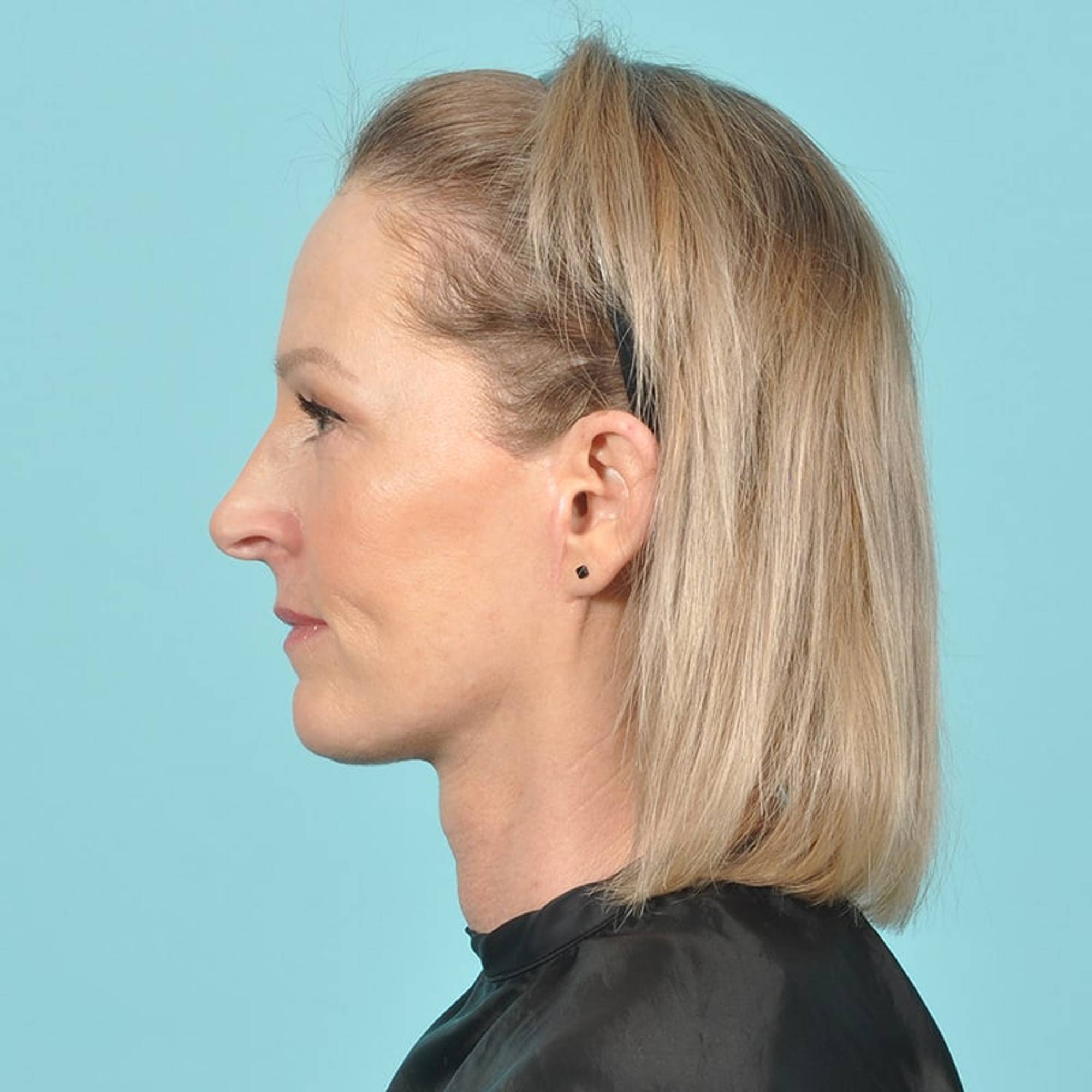 Blepharoplasty Before & After Image