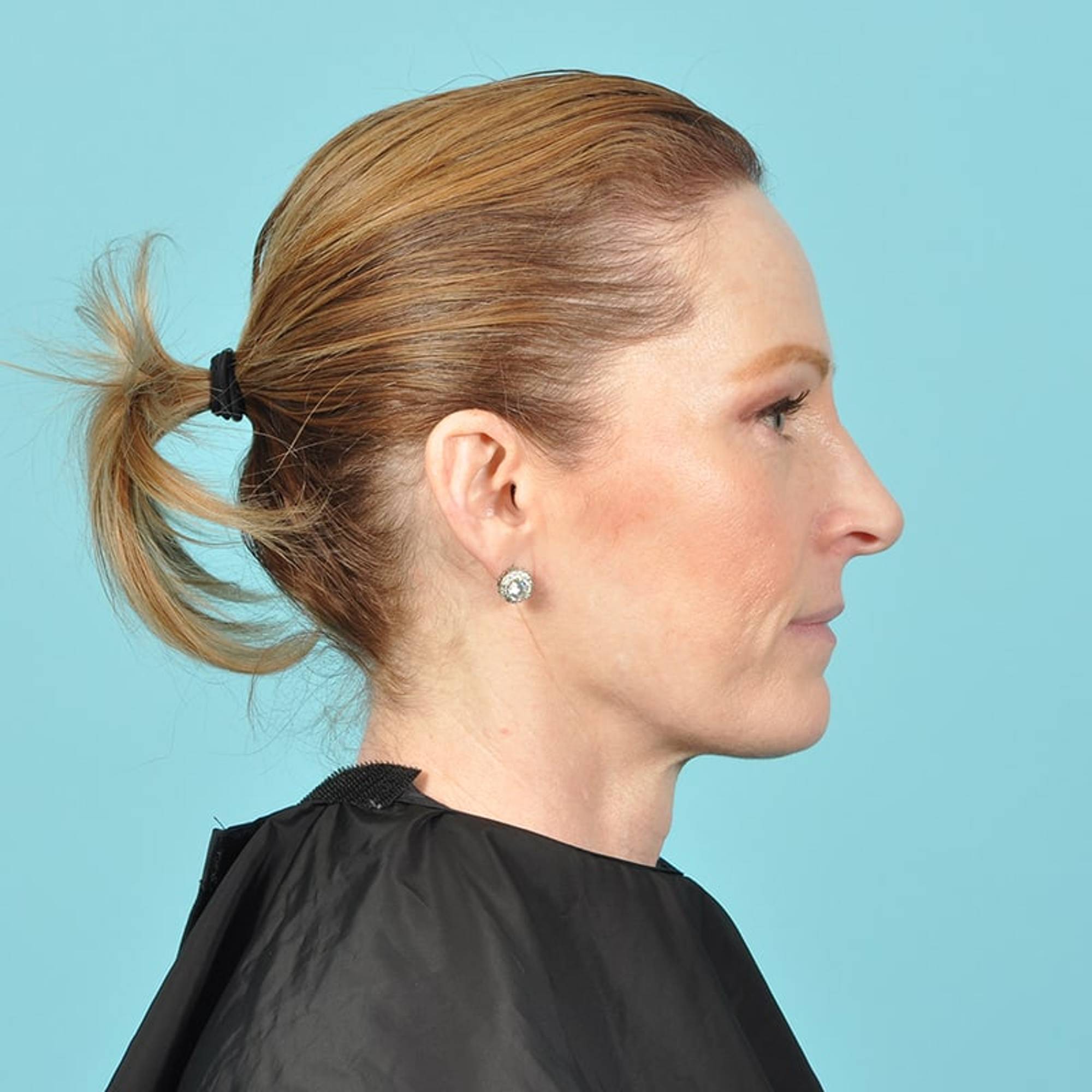 Blepharoplasty Before & After Image