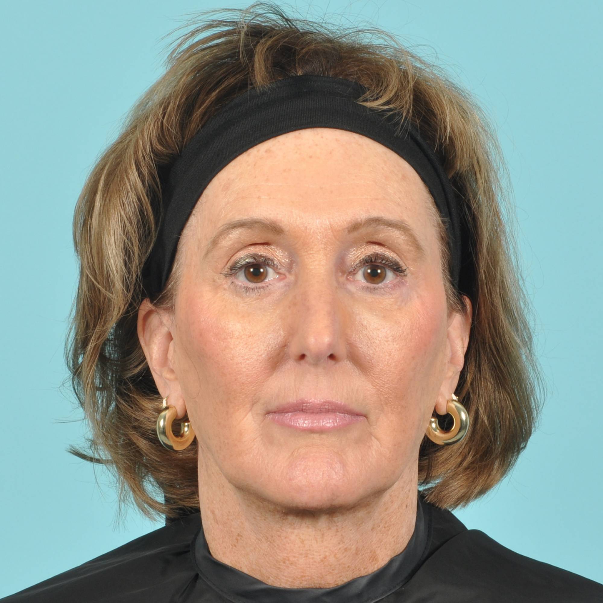 Blepharoplasty Before & After Image