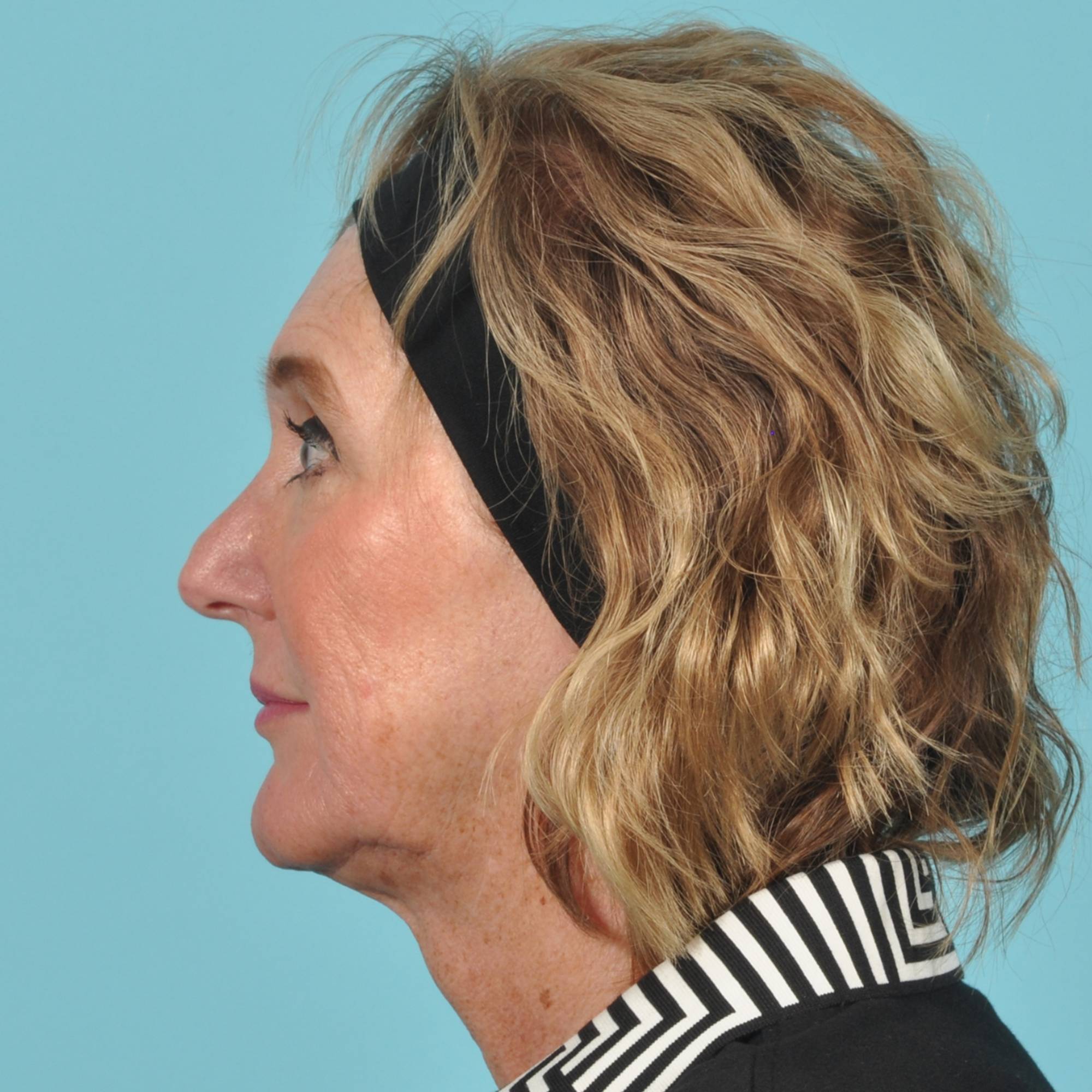 Blepharoplasty Before & After Image