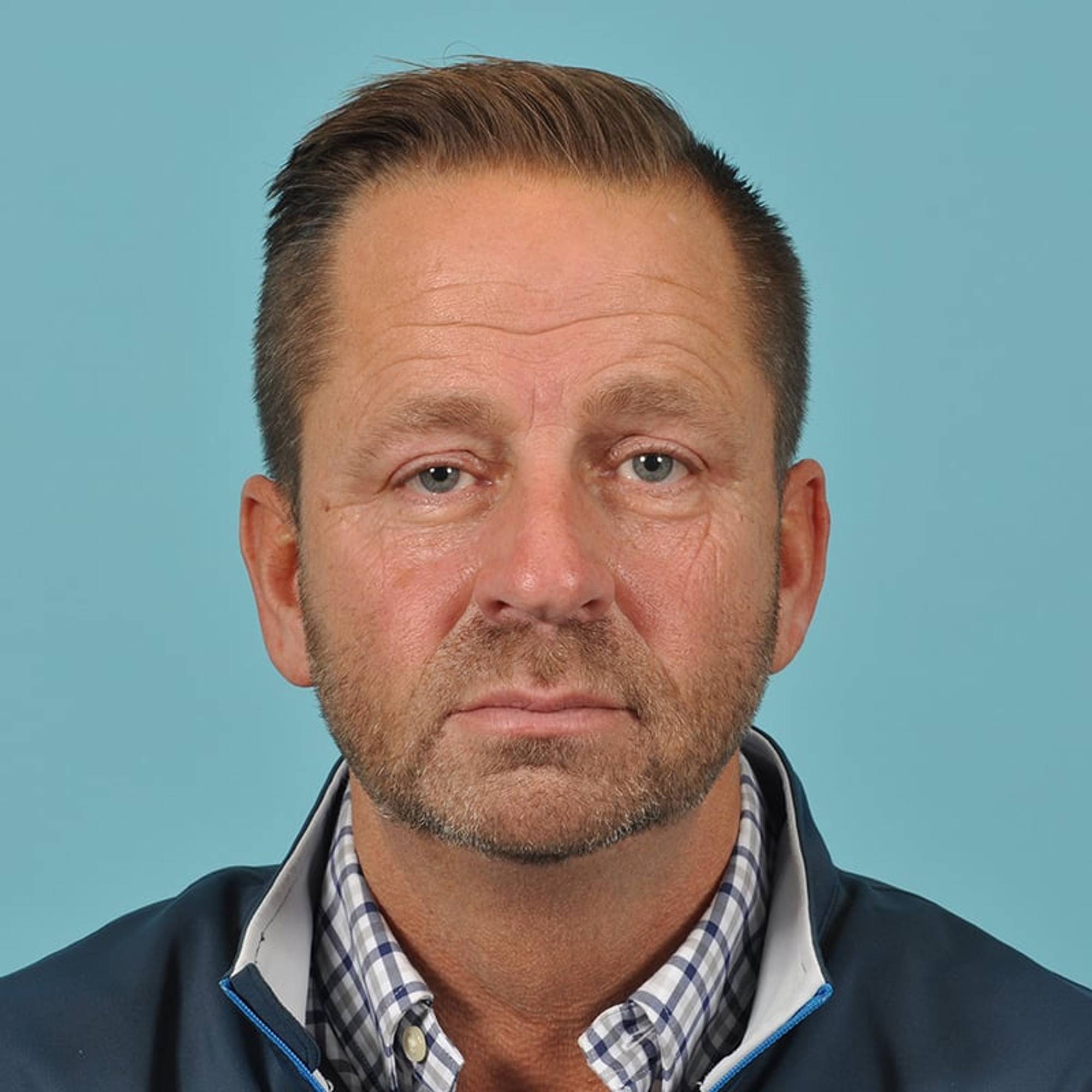 Blepharoplasty Before & After Image