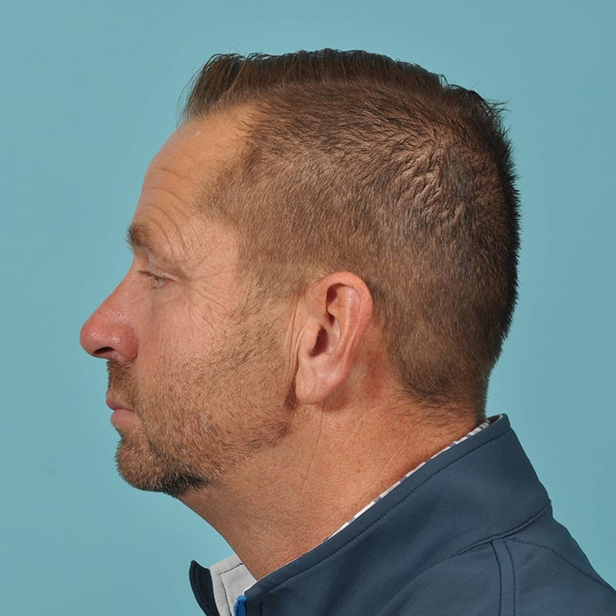 Blepharoplasty Before & After Image