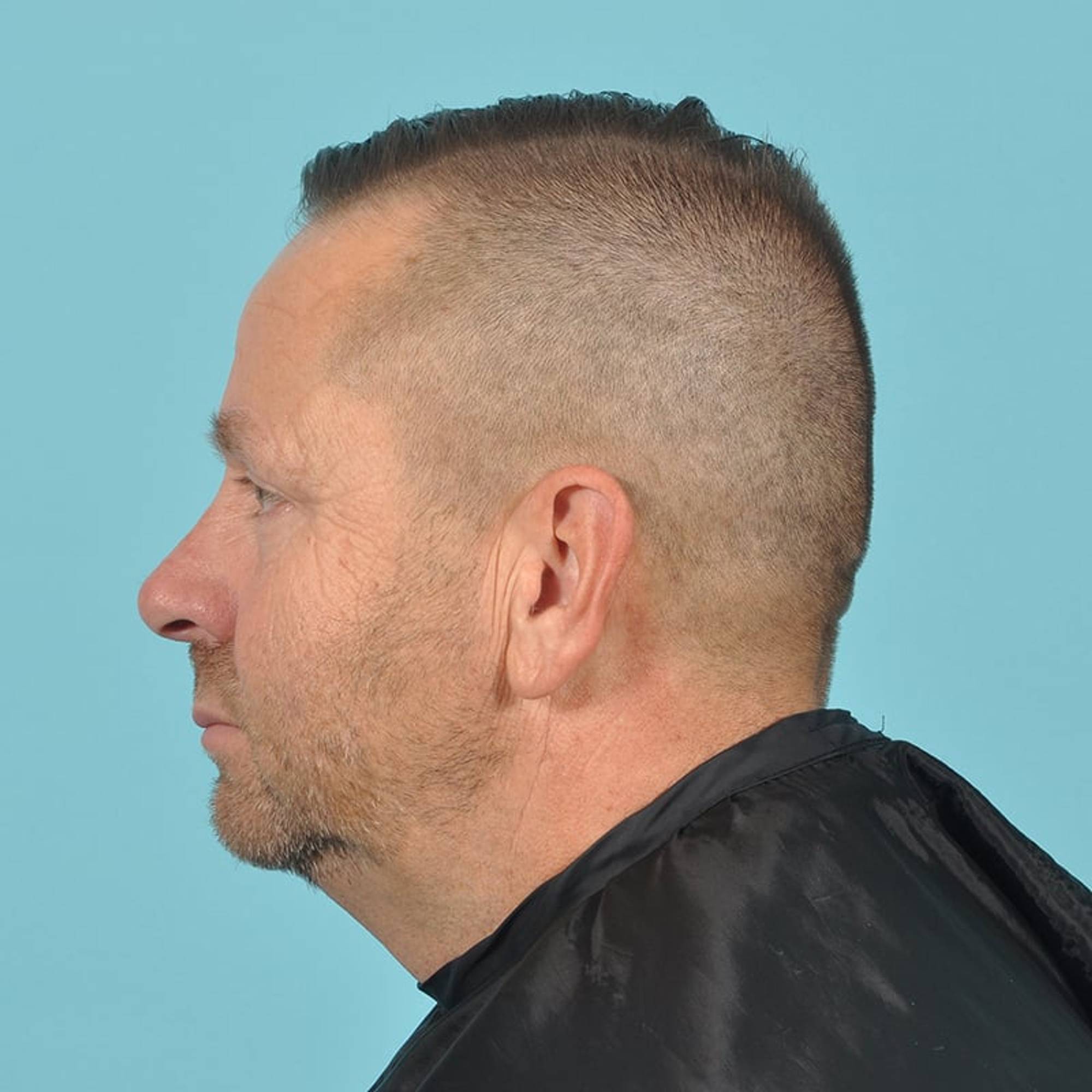 Blepharoplasty Before & After Image