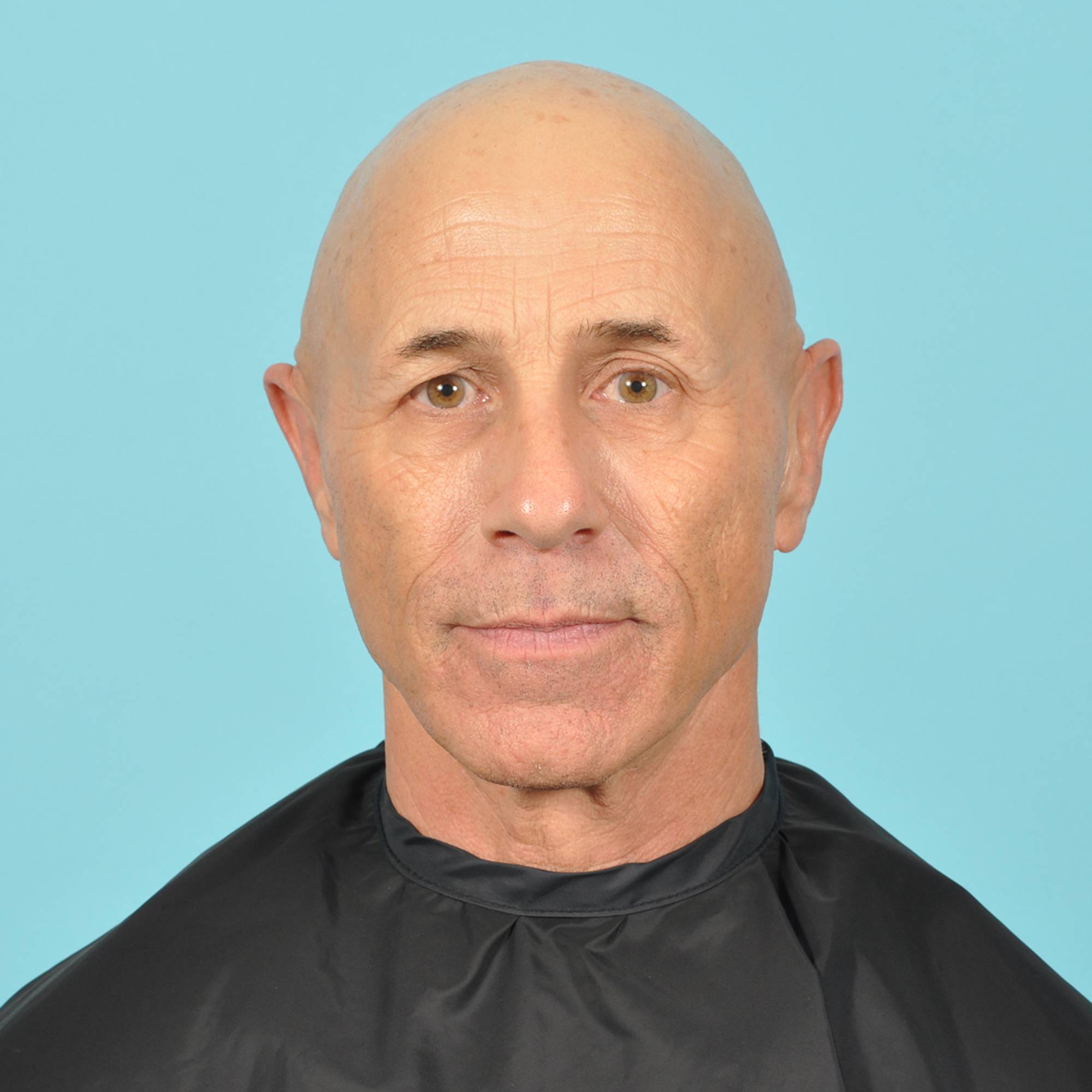 Blepharoplasty Before & After Image