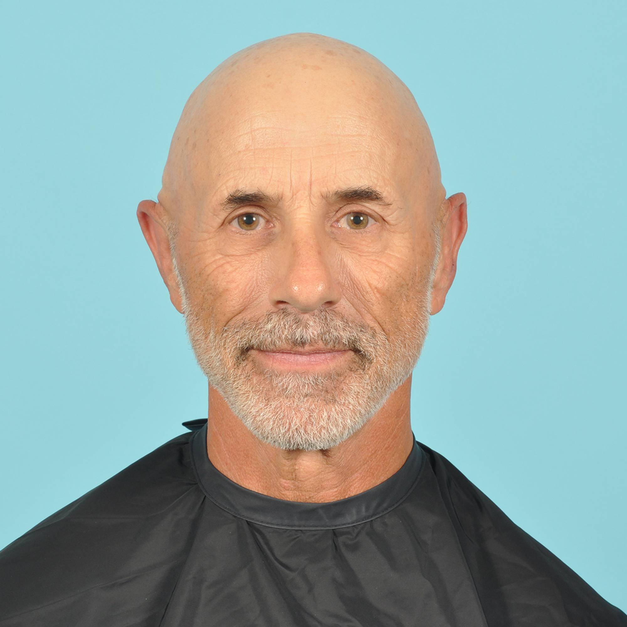 Blepharoplasty Before & After Image