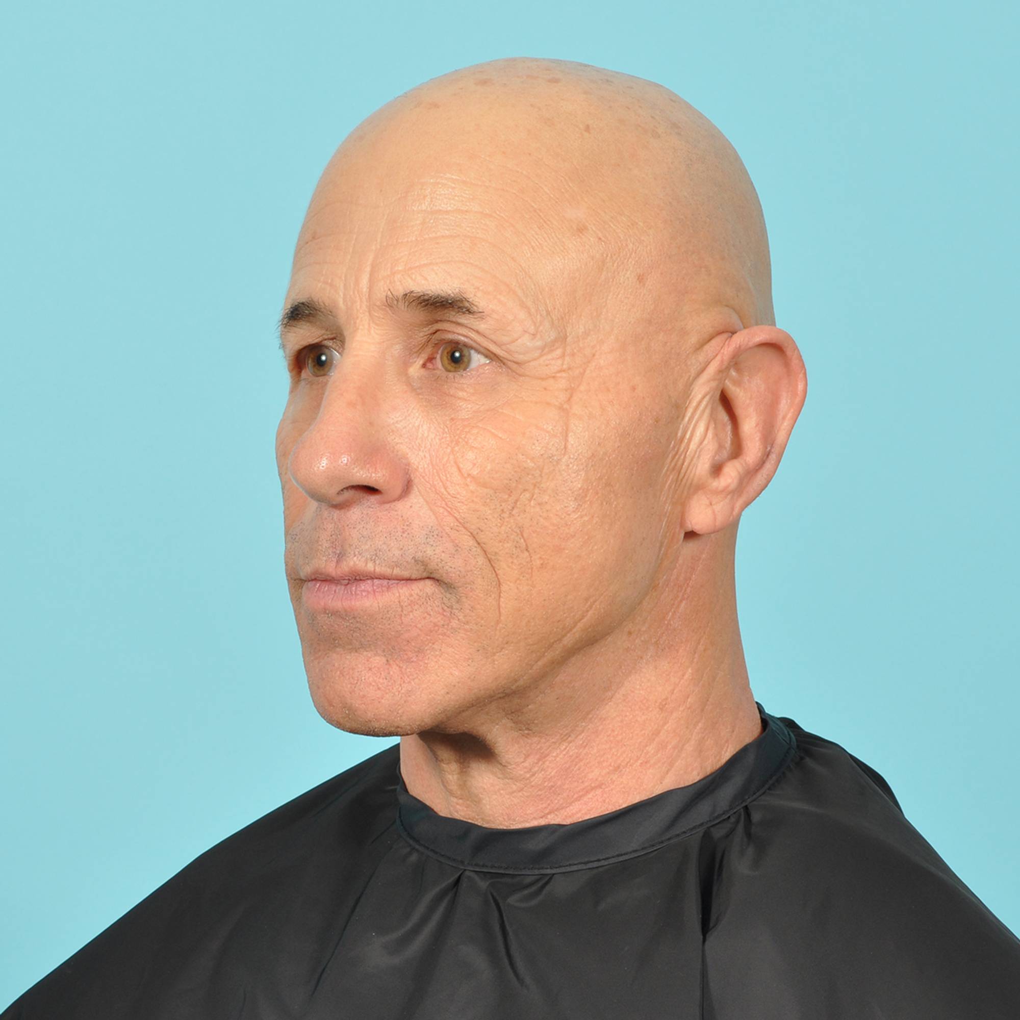 Blepharoplasty Before & After Image