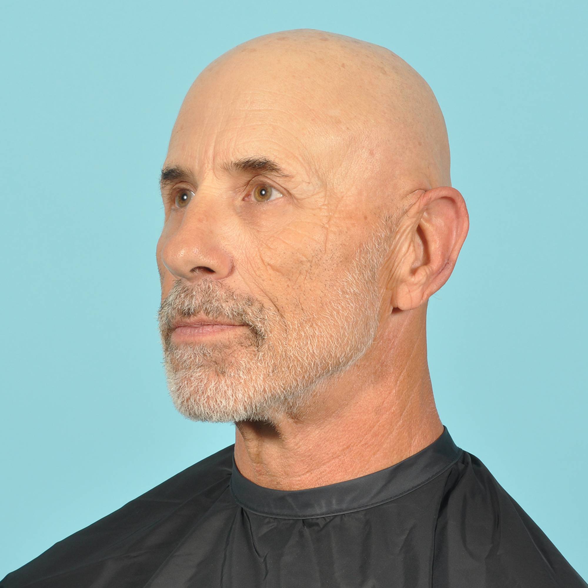 Blepharoplasty Before & After Image