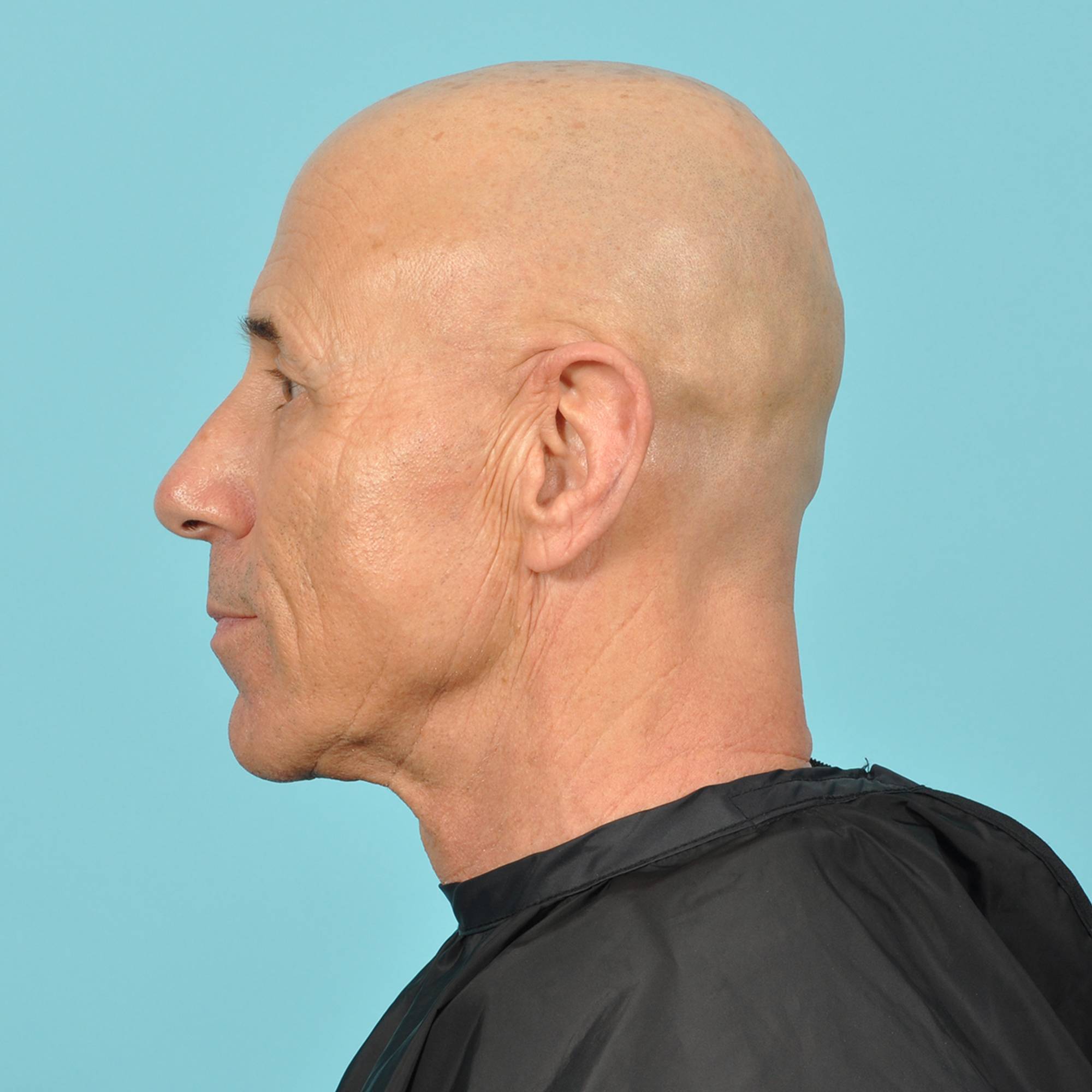 Blepharoplasty Before & After Image