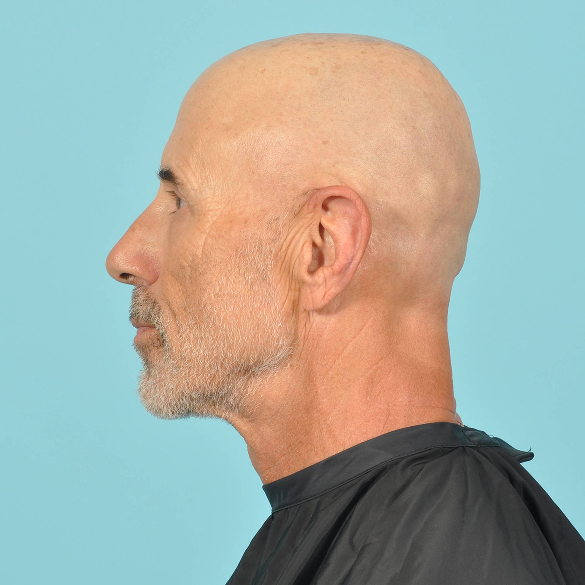 Blepharoplasty Before & After Image