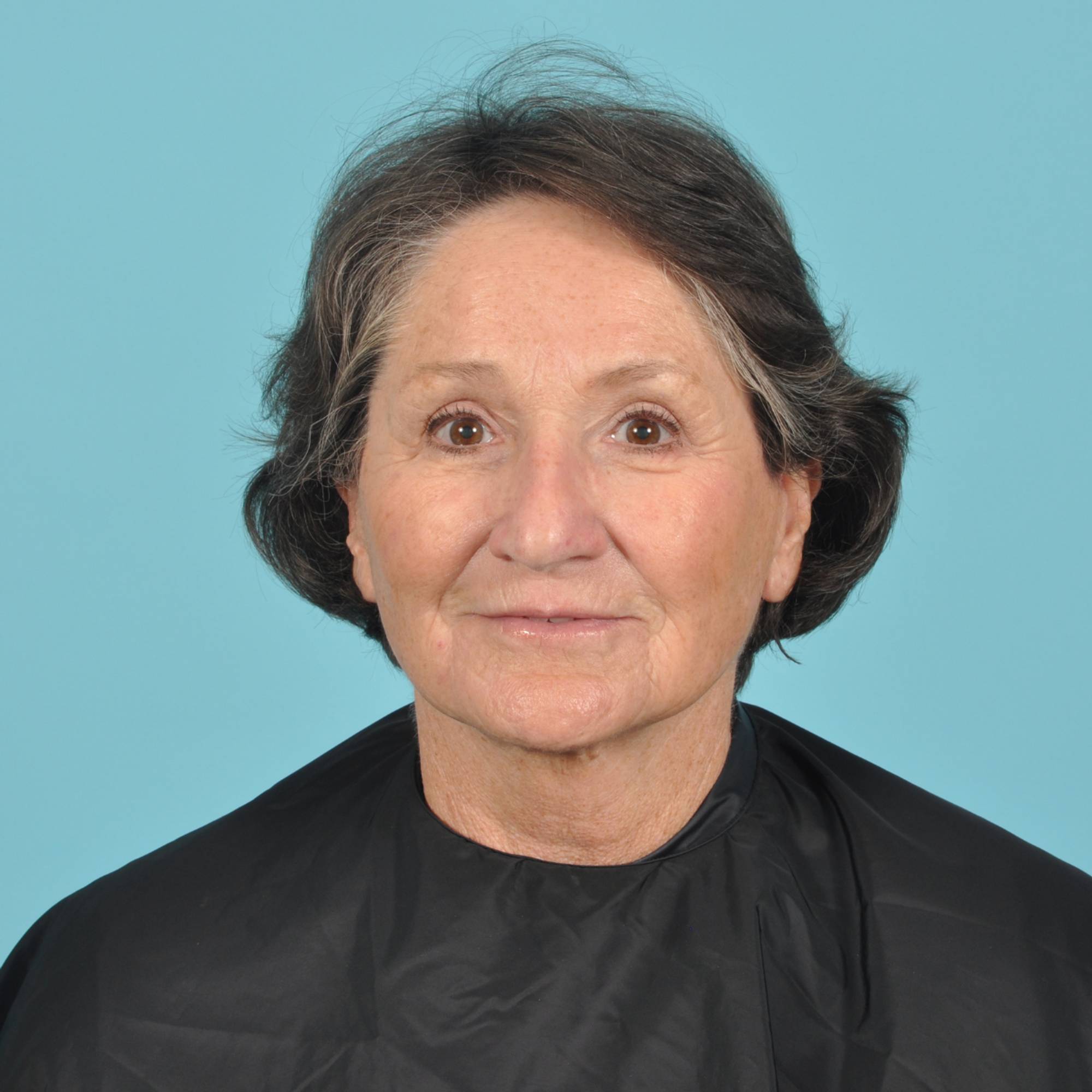 Blepharoplasty Before & After Image