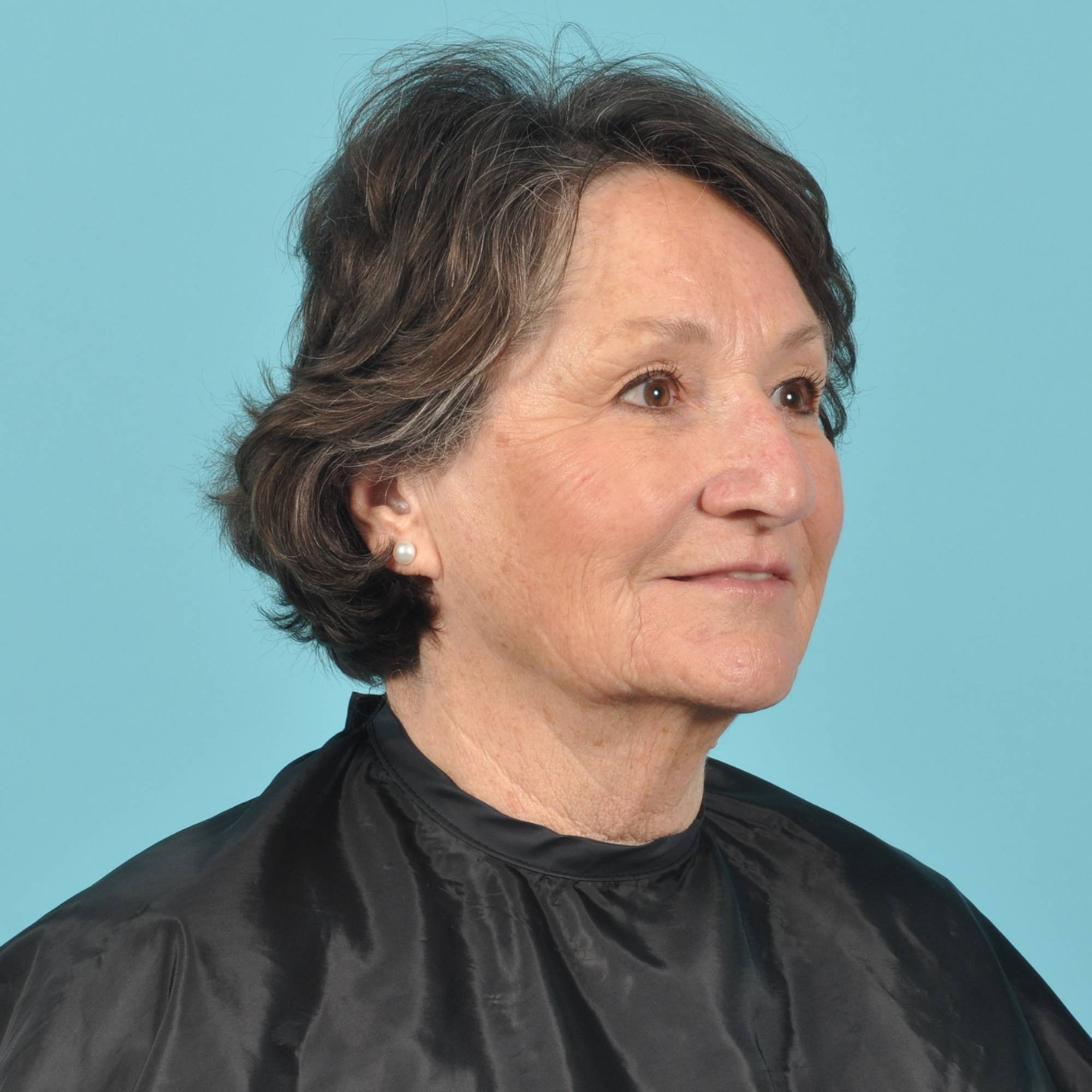 Blepharoplasty Before & After Image